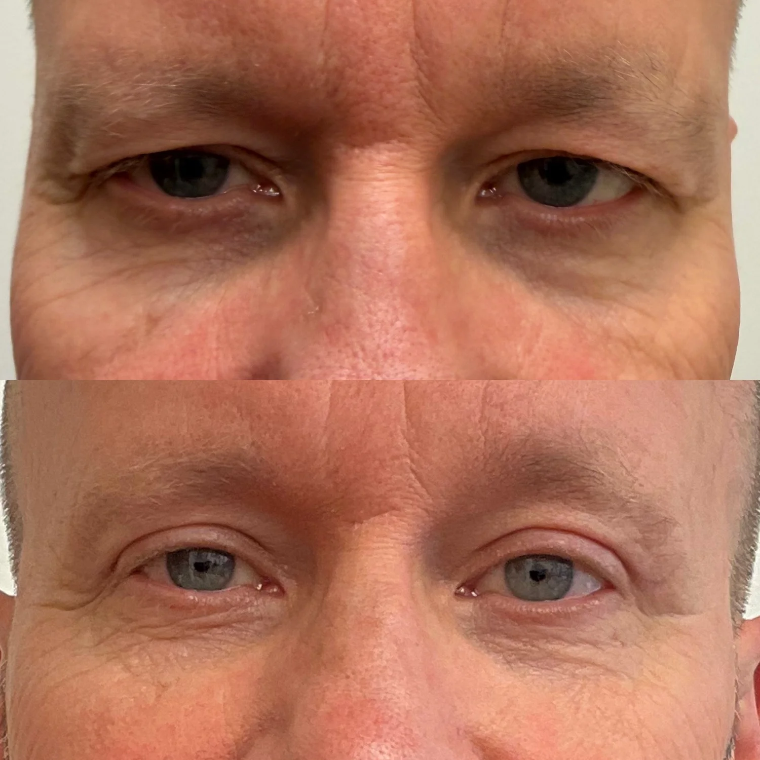 Male Upper Eyelid Blepharoplasty before and after — Dramatic result of excess skin on the upper eyelids affecting vision and reading with natural results showcasing improvement in vision and aesthetic results.