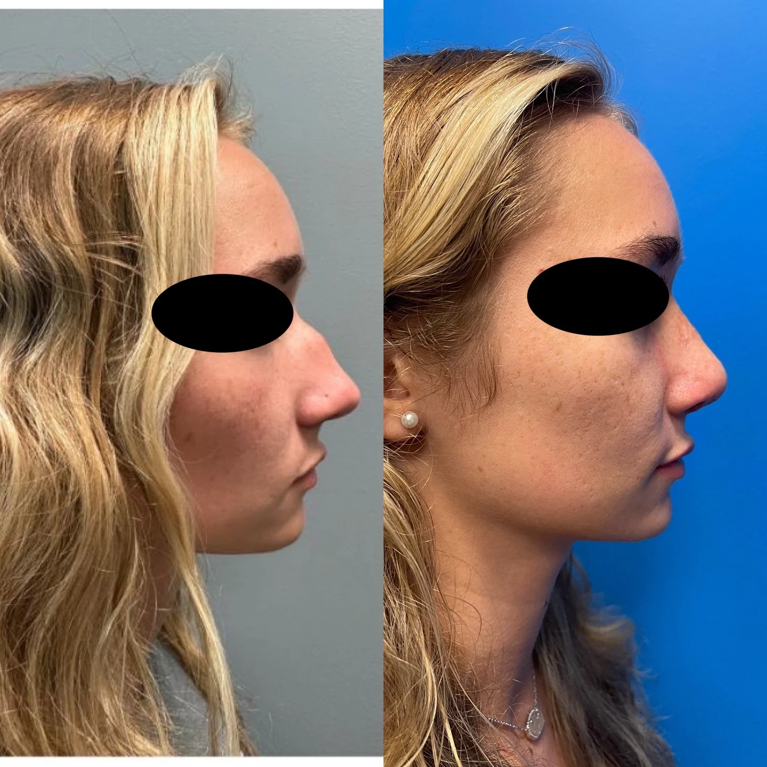 Rhinoplasty with Septoplasty before and after — 6 months out from surgery — reduction in nasal hump with natural subtle changes.