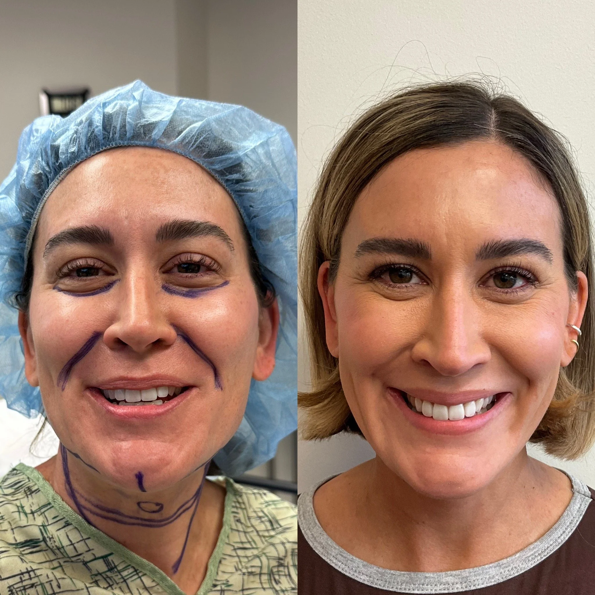 Lower Eyelid Blepharoplasty, Facial Fat Transfer, Nostril Narrowing - This beautiful patient desired subtle fullness added back to the lower eyelid / cheek area to restore youthful volume loss following multiple pregnancies. Fat harvested and transfe