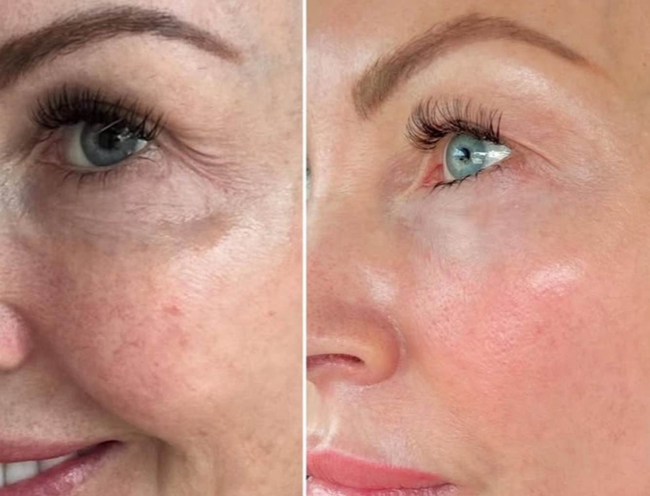 Side-by-side comparison of a woman's face showing skin improvement; left side with wrinkles, uneven skin tone, and blemishes; right side with smoother, clearer skin.