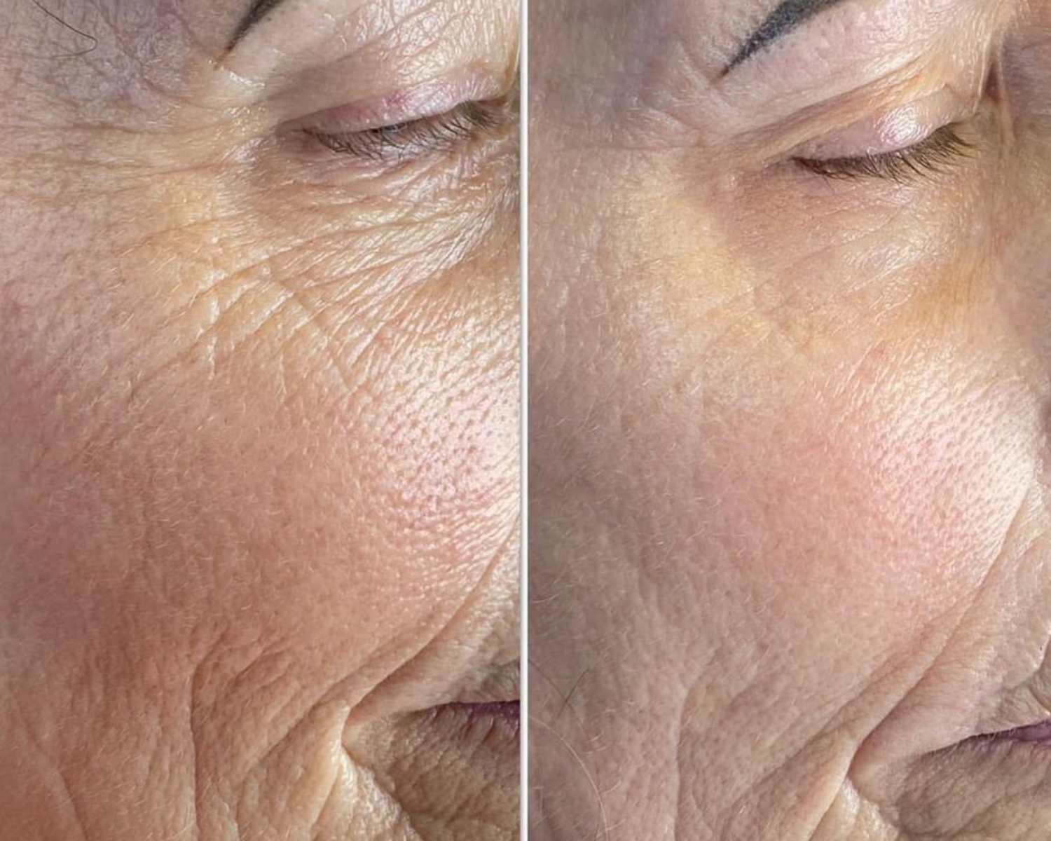 Close-up comparison of facial skin showing reduction of wrinkles and smoother texture on right after treatment or skincare.