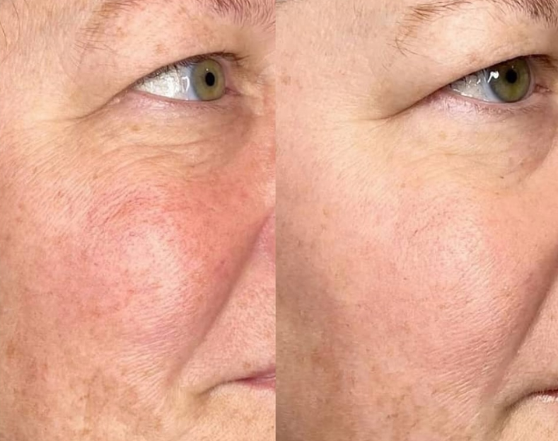 Close-up of a woman's face showing a side-by-side comparison of skin before and after skincare, highlighting improved skin texture and reduction of redness.