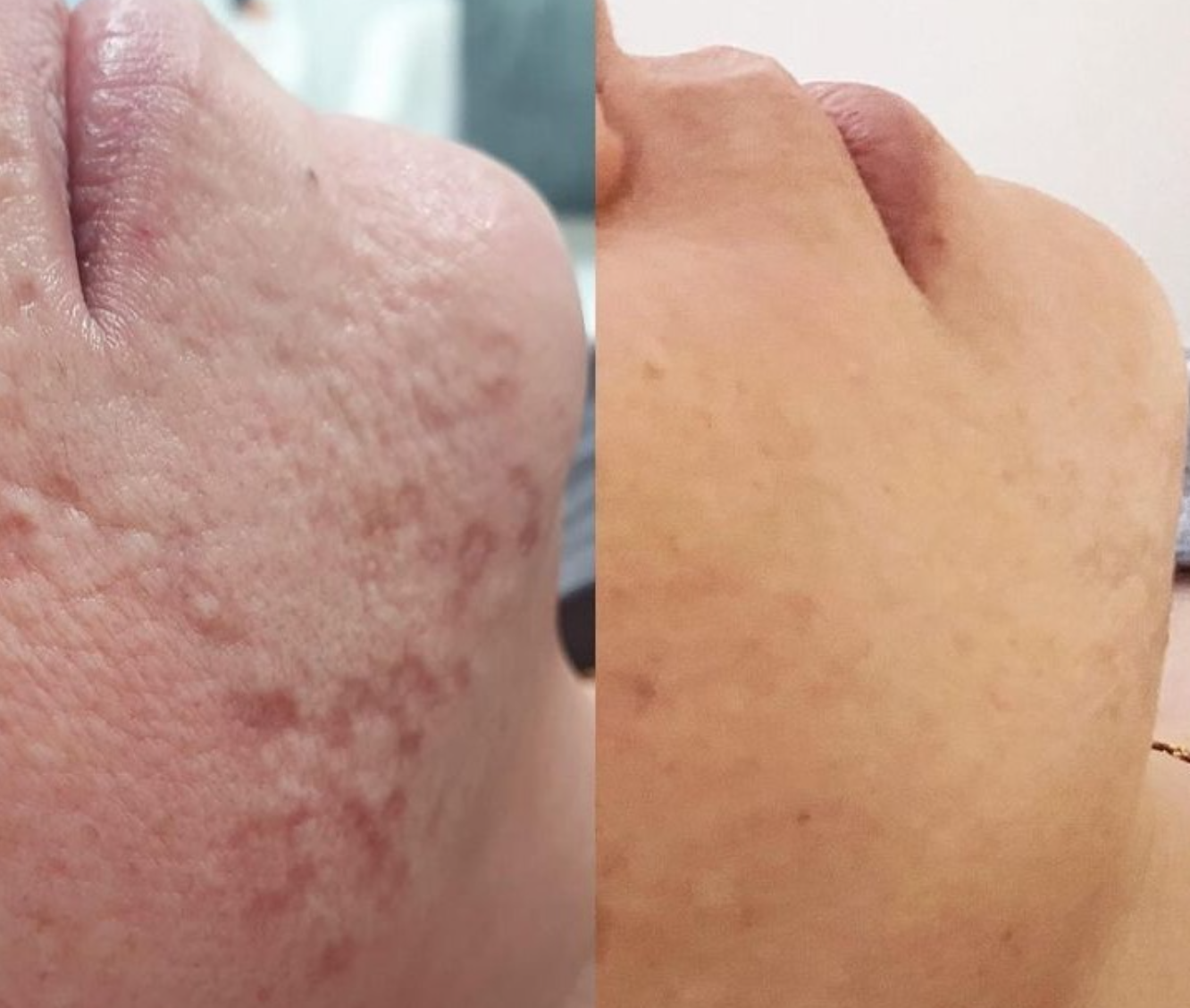 Side-by-side comparison of a nose, showing skin with acne scars and redness on the left, and smooth, clear skin on the right.