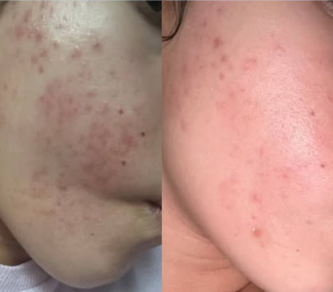 Comparison of skin with acne scars and red bumps on the cheek before and after treatment.