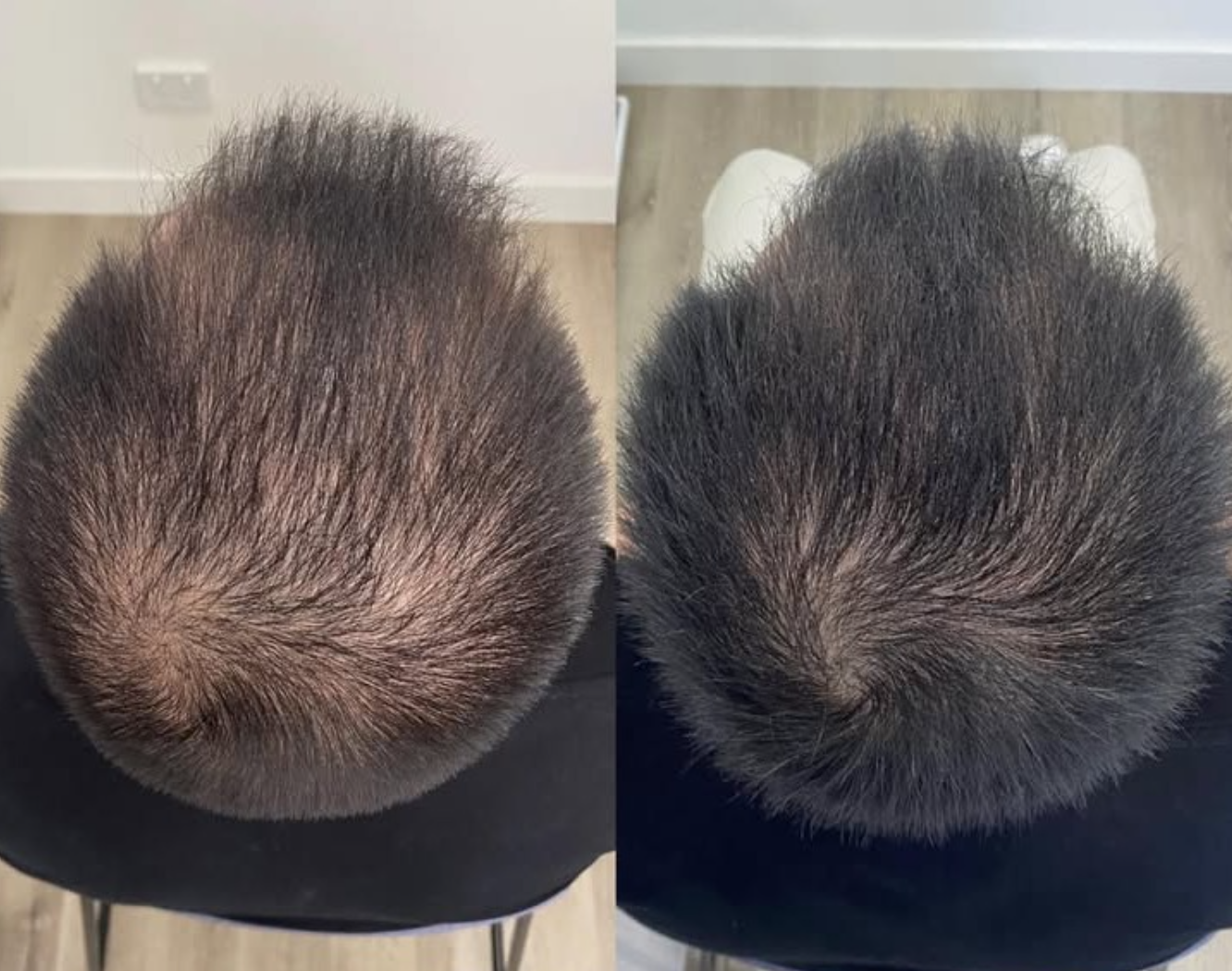 Comparison of a person's scalp before and after a hair treatment, showing increased hair density and coverage in the after image.