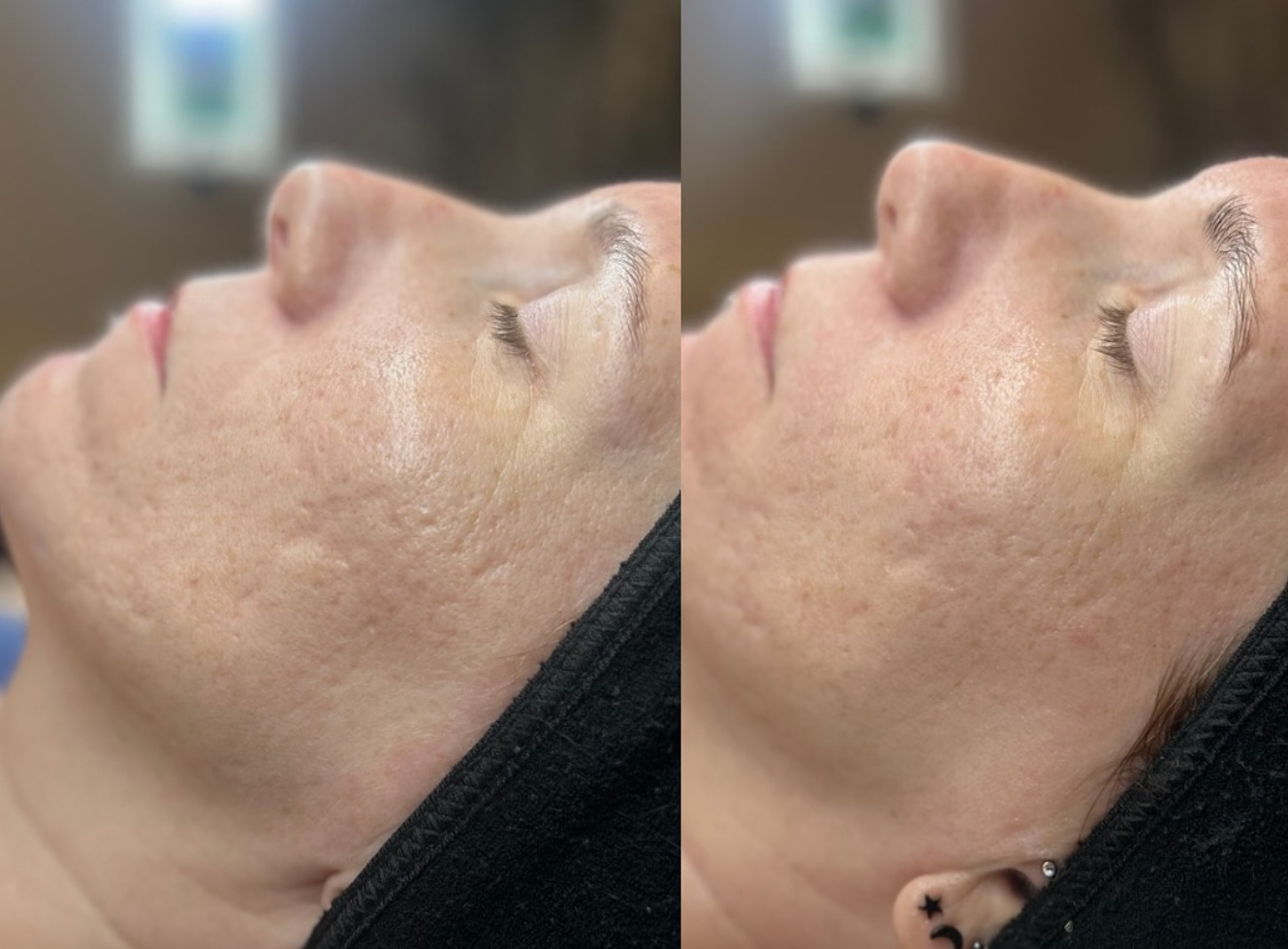 Close-up side view of a woman's face before and after skincare treatment, showing improved skin texture and redness reduction.