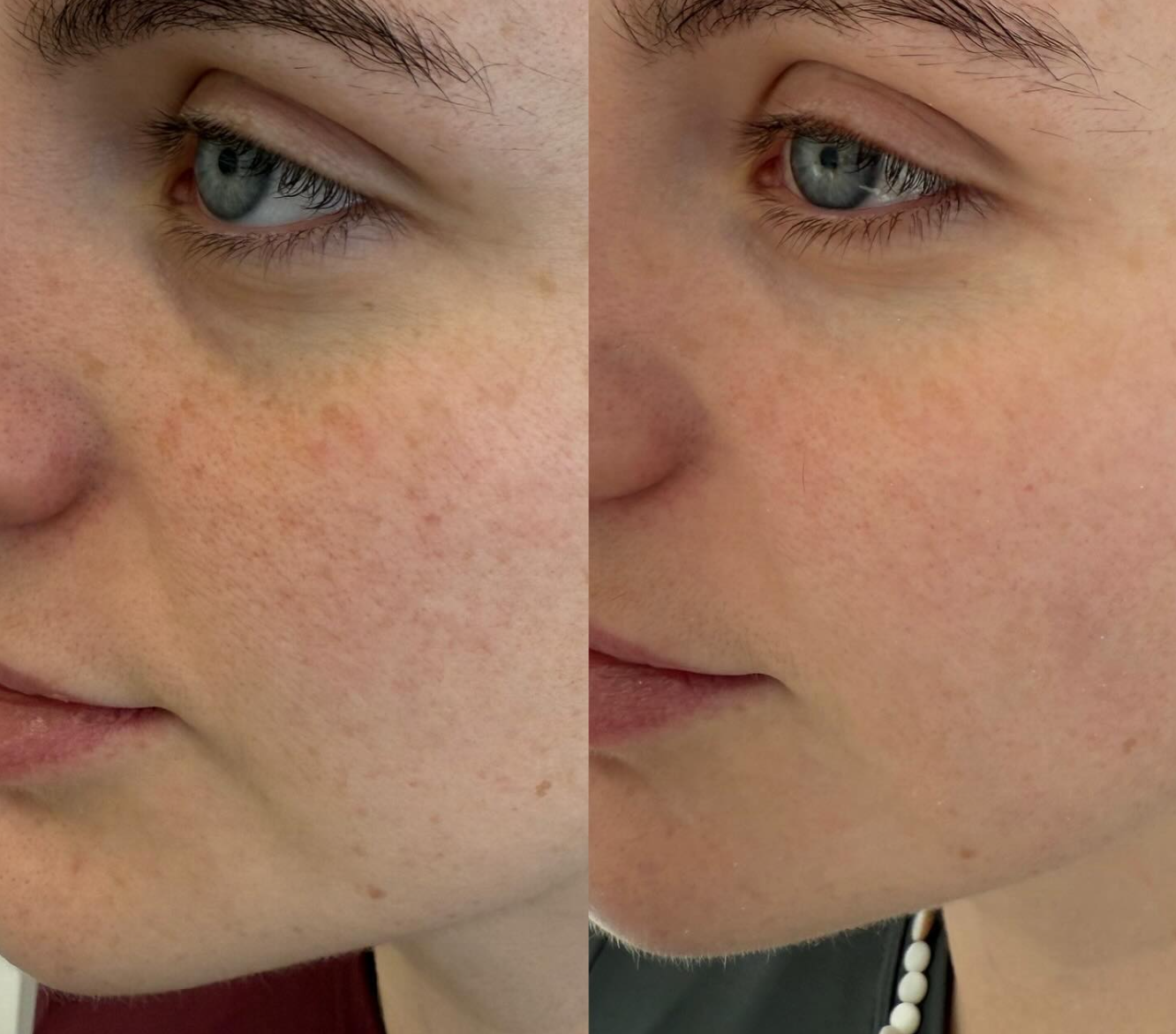 Side-by-side comparison of a person's face showing improvement in skin texture and redness reduction.