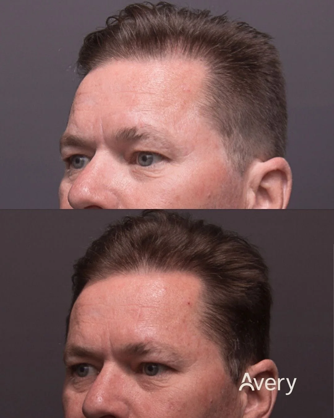 Comparison of a man's hairline before and after hair restoration or hair transplant, showing fuller hair after treatment.