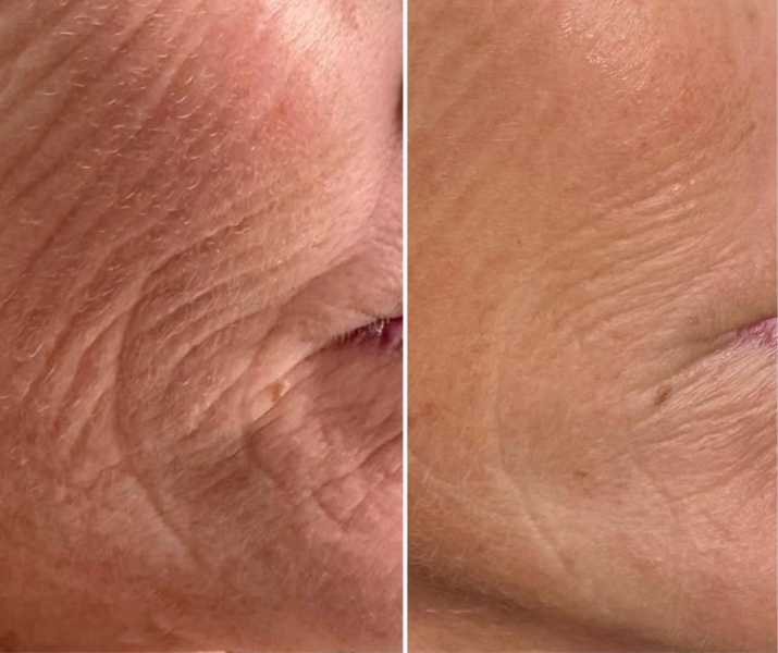 Close-up comparison of skin wrinkles around the corner of an eye, showing reduction in wrinkles in the after image.