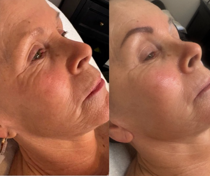 Side-by-side comparison of a woman before and after skincare treatment showing smoother skin and fewer wrinkles.
