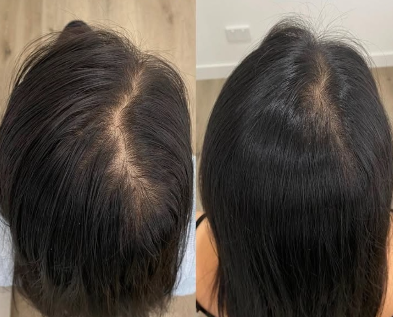 Comparison of a person's scalp showing hair thinning and hair before and after treatment, with fuller hair after treatment.