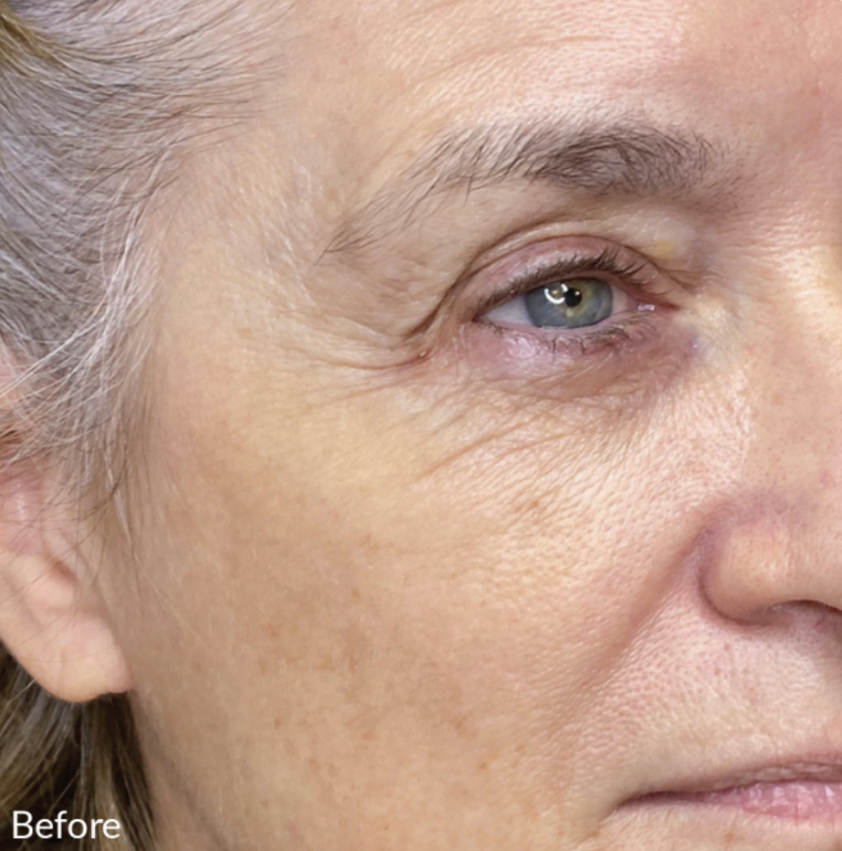 Close-up of a woman's face showing signs of aging such as wrinkles and fine lines around the eye and cheek area.