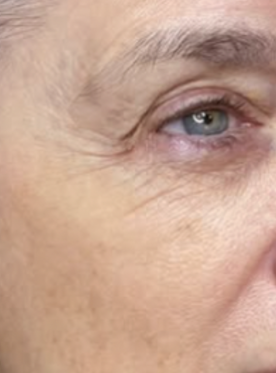 Close-up of a person's eye and surrounding skin, showing light blue eye color and some wrinkles.