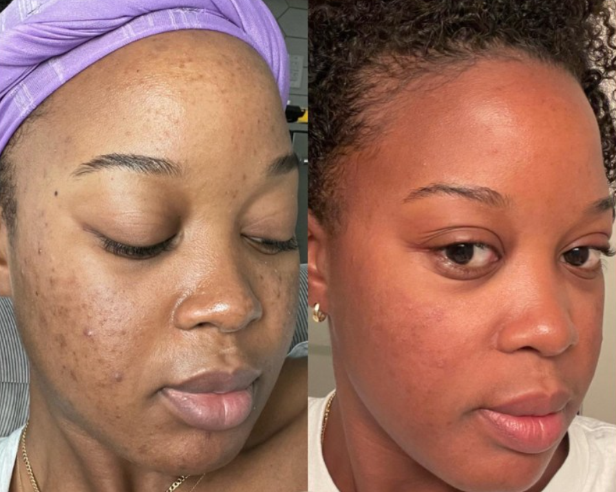 Side-by-side comparison of a woman before and after her skin treatment, showing significant reduction in acne scars and improving skin texture.