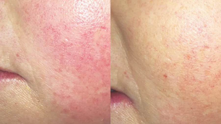 Close-up of a person's cheek showing before and after treatment for skin redness, with the left side displaying more redness and the right side showing clearer skin.
