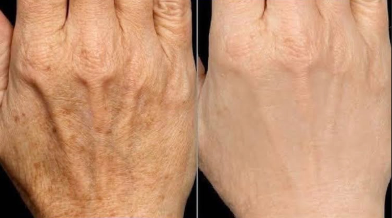 A side-by-side comparison of a hand with deep wrinkles and age spots on the left, and the same hand with smoother skin and fewer wrinkles on the right.