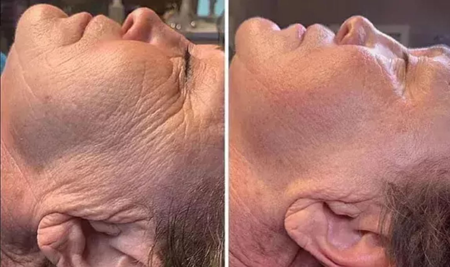 Side-by-side comparison of a person's face showing a before and after transformation, focusing on skin texture and aging signs, with the left image showing aged skin with wrinkles and the right image showing smoother skin.