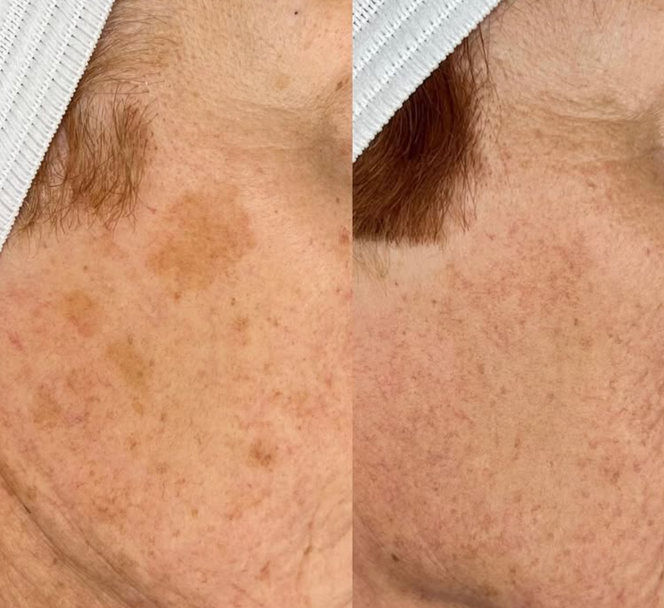 Side-by-side comparison of a person's cheek showing before and after skin treatment results, with visible reduction in dark spots and pigmentation, wearing a white headband.
