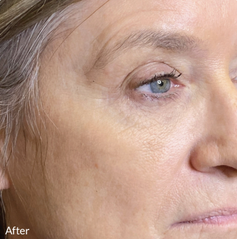 Close-up of a middle-aged woman's face showing improved skin texture and reduced wrinkles around the eye, labeled 'After'.