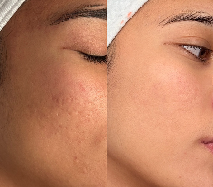 Comparison of a person's cheek before and after skincare, showing reduced acne scars and smoother skin in the after photo.