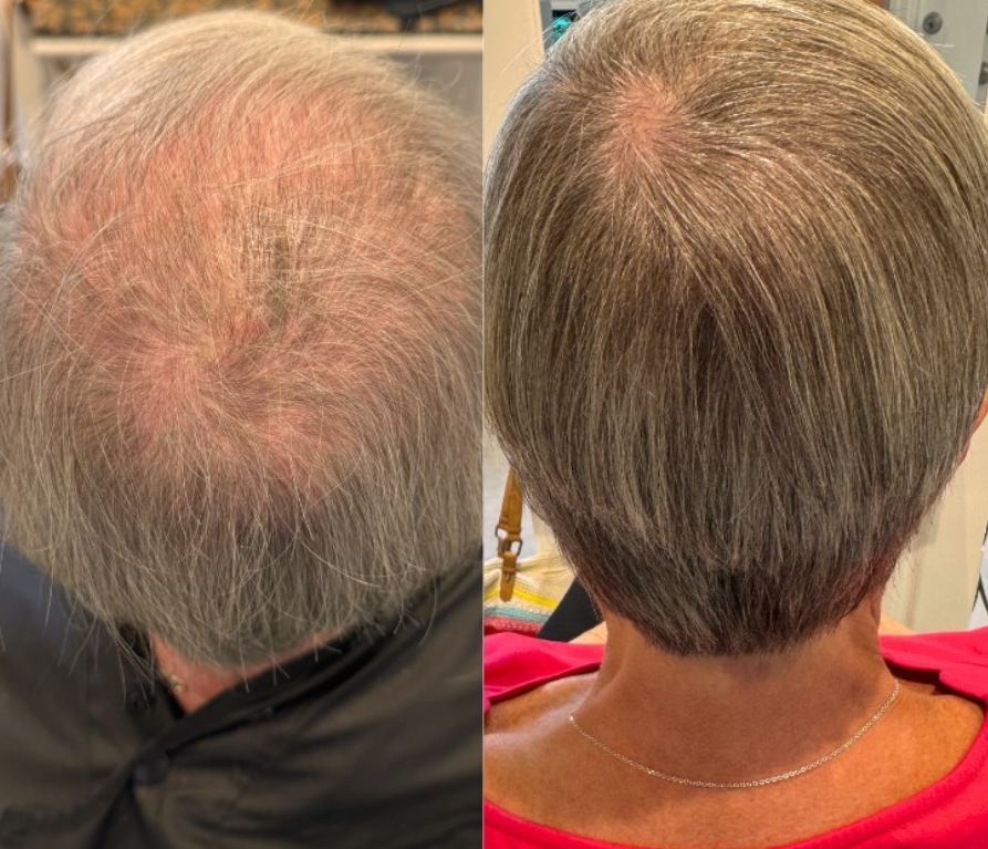 Side-by-side comparison of a person's scalp before and after hair restoration, showing significant increase in hair density and coverage.