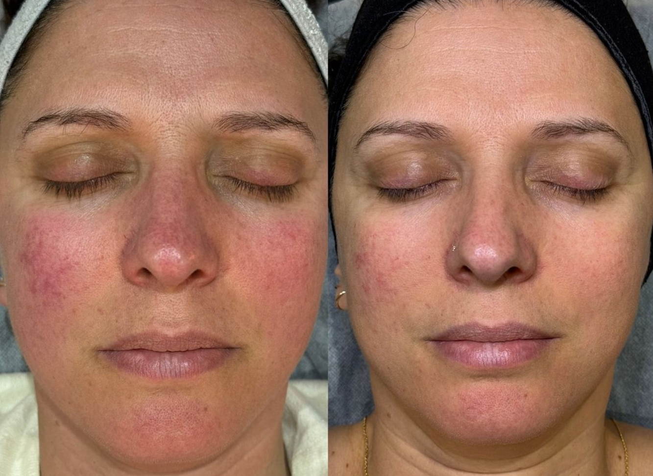 Close-up of a woman's face before and after skincare treatment, showing reduction in redness and improved skin texture.
