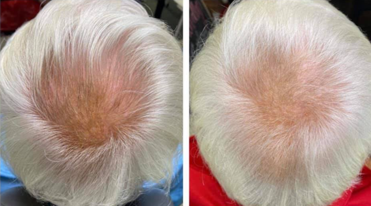 Comparison of two top-down views of an elderly person's scalp showing hair thinning; the left side has more visible scalp with light-colored thinning hair, the right side shows improved hair density with less scalp visible.