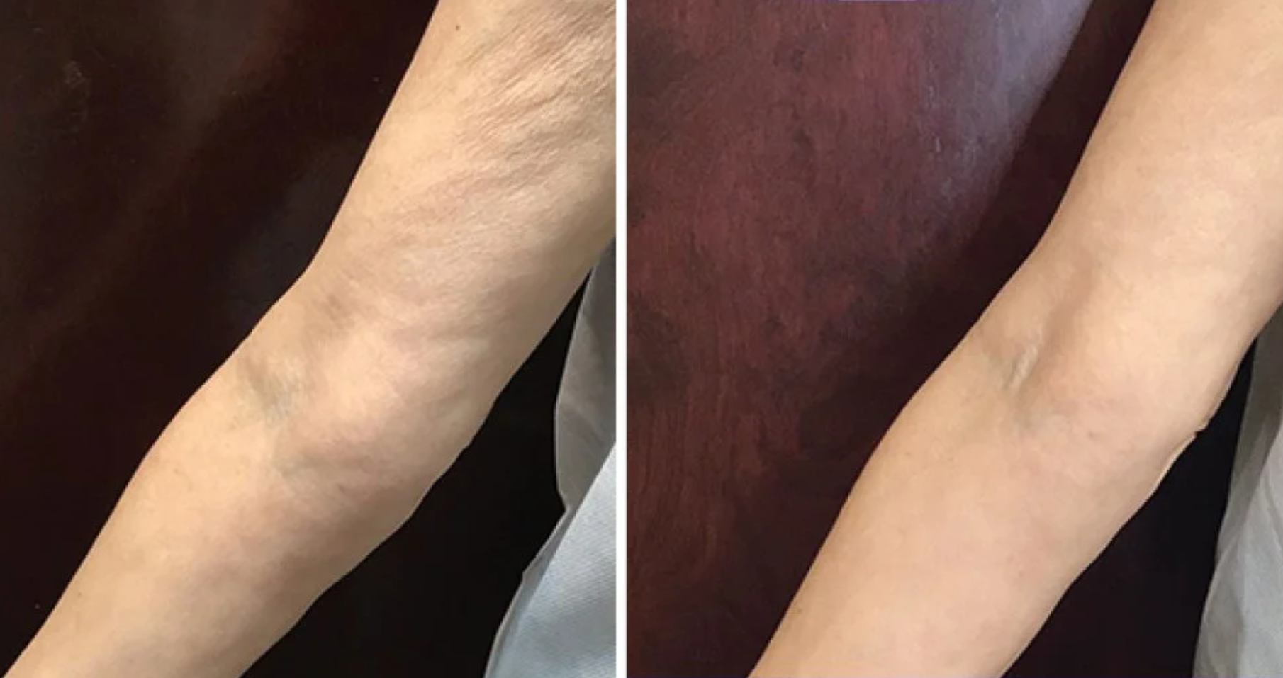 Side by side comparison of a person's lower leg and foot showing skin before and after treatment, with the left image displaying more uneven skin and the right showing smoother skin.