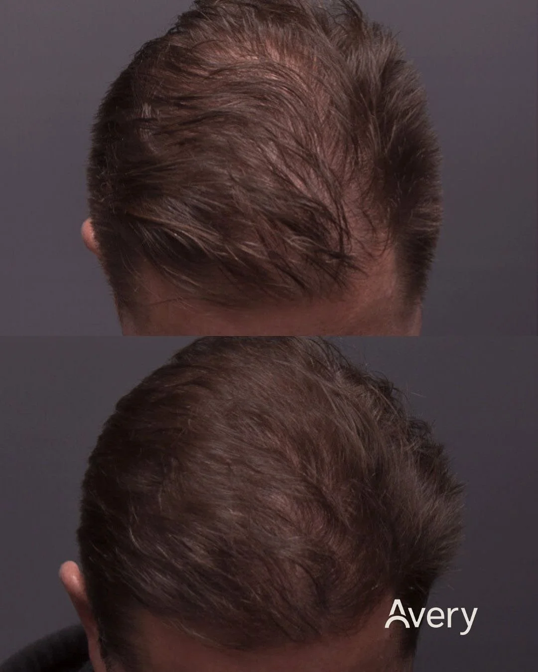 Comparison of a person's hair before and after hair treatment, showing increased hair density and fullness.