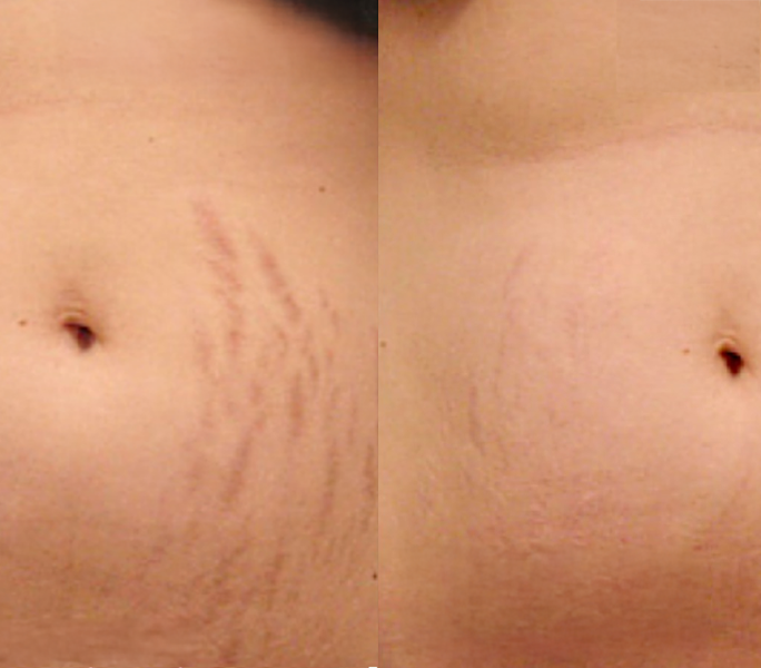 Comparison of a torso before and after stretch mark treatment showing reduction in appearance of stretch marks.