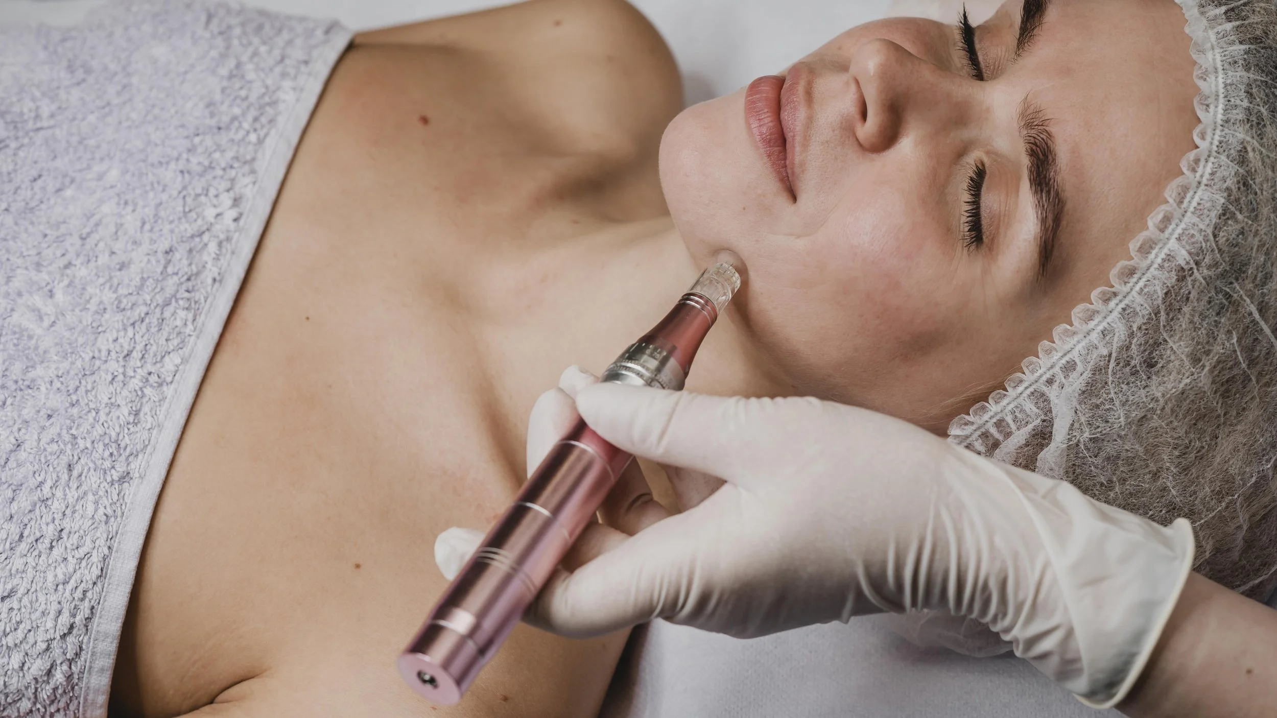Microneedling for Acne Scars, Pores &amp; Fine Lines | Mississauga Skin Rejuvenation