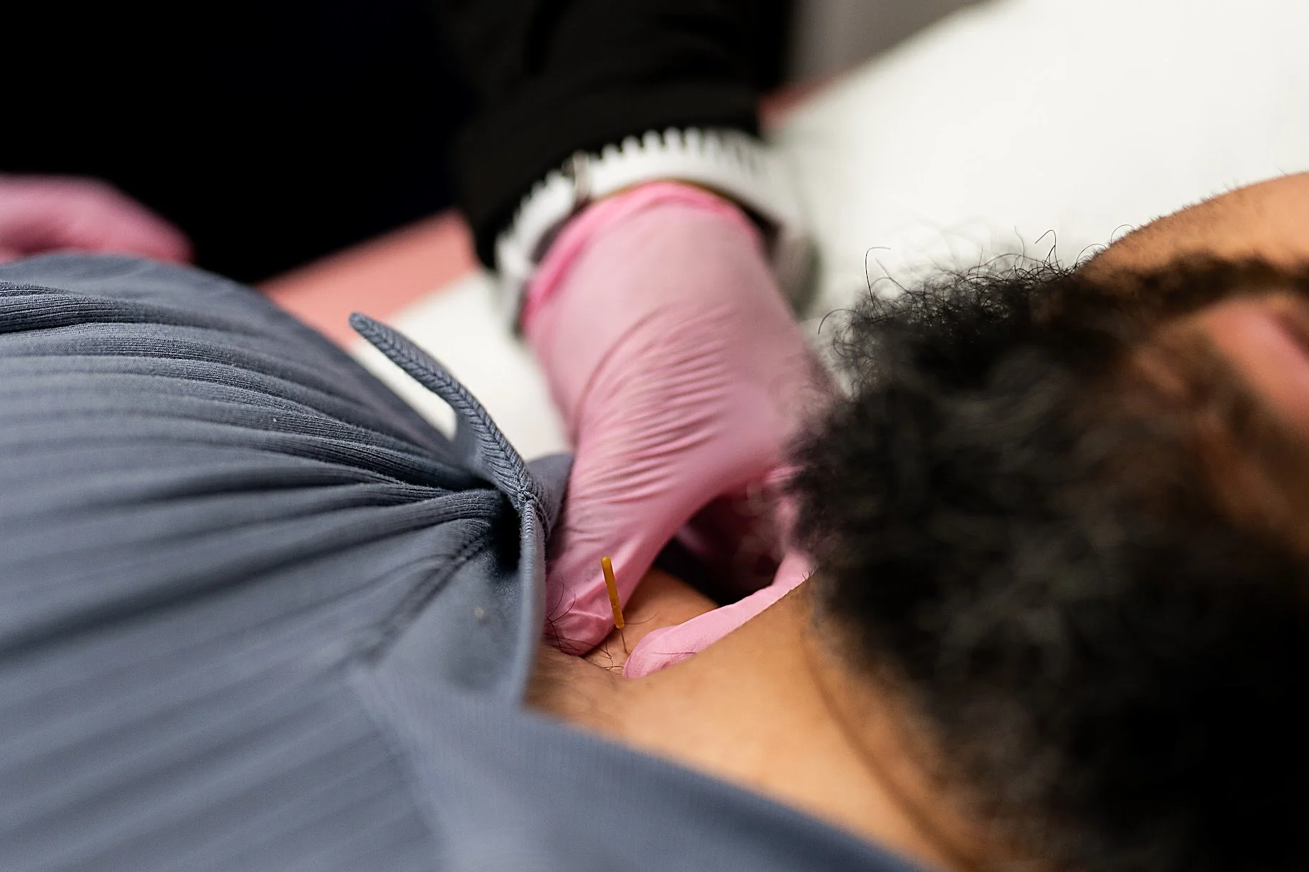 DRY NEEDLING