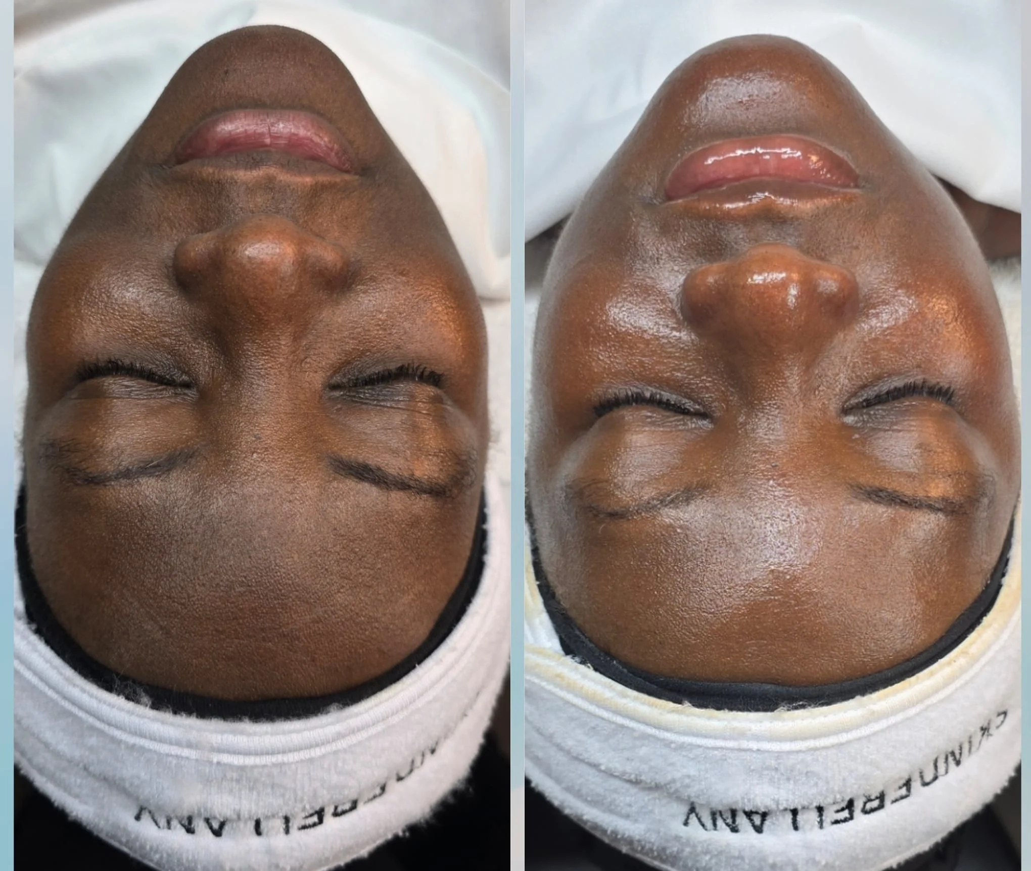 Side-by-side comparison of a person's face before and after a skincare treatment, showing improved skin texture and glow.
