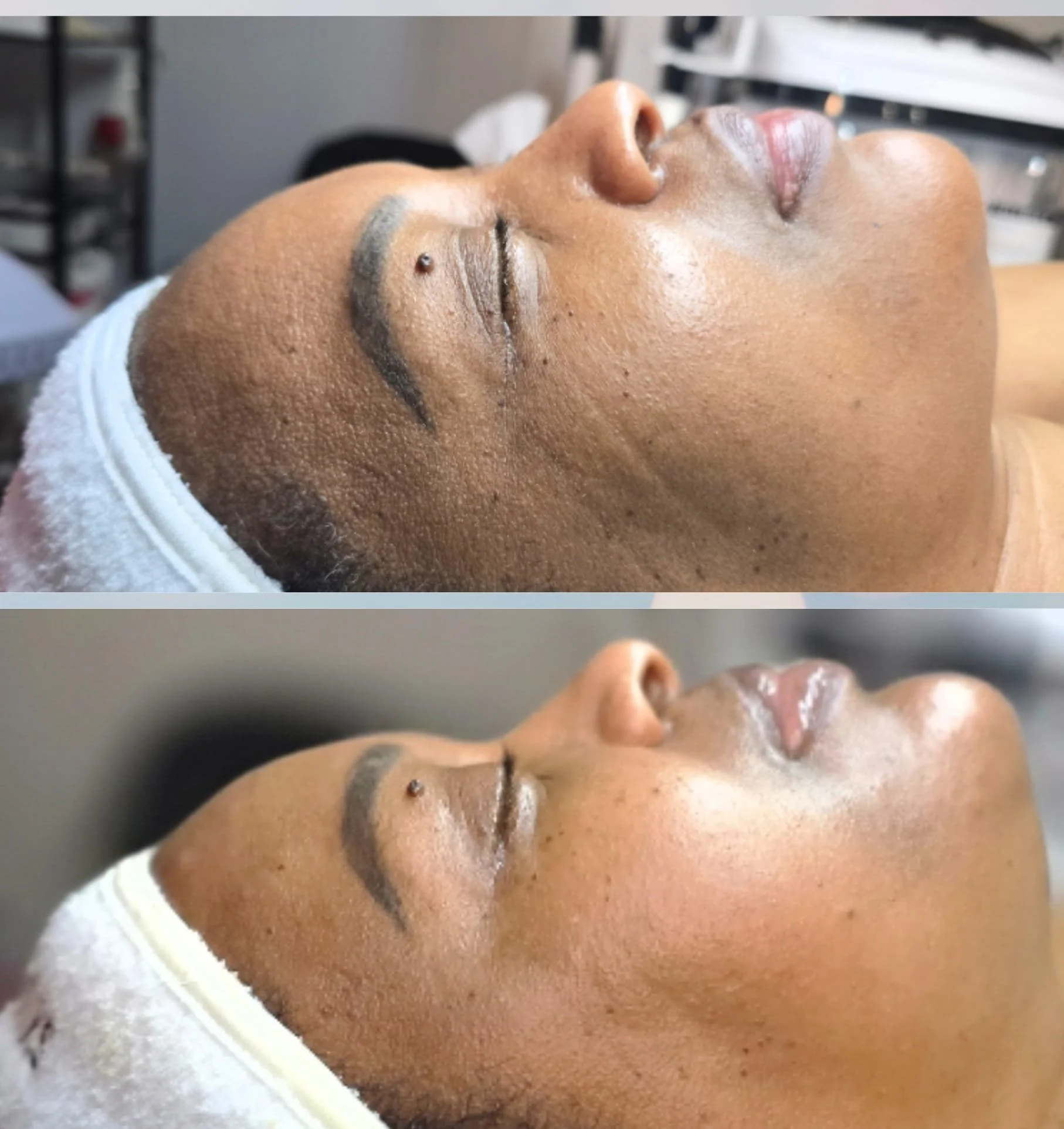 Close-up of a woman receiving a facial treatment, lying down with her eyes closed, in a spa or clinic setting, with a white headband around her hair.