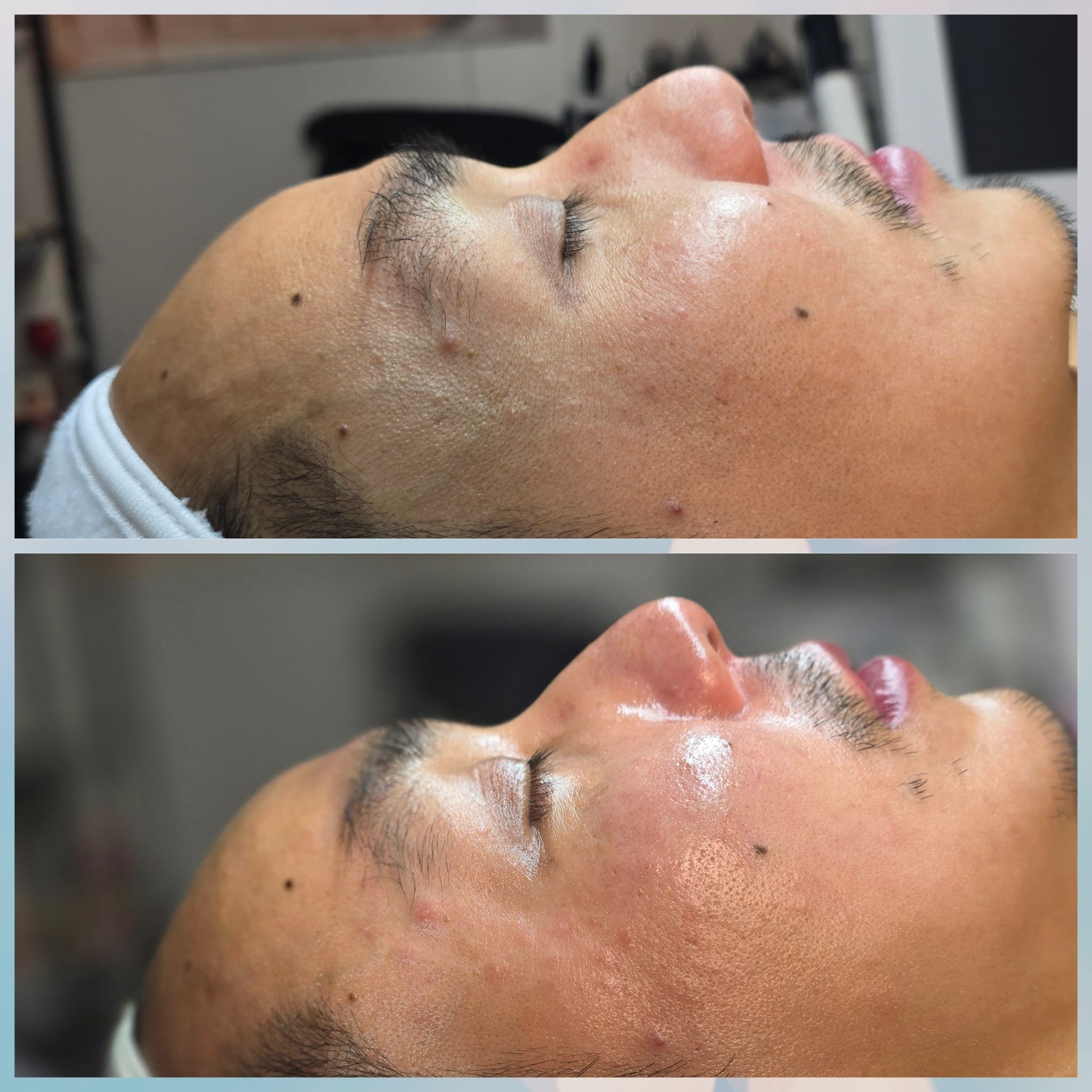 A side-by-side comparison of a person's face before and after a skincare treatment, showing clearer and more radiant skin in the after image.