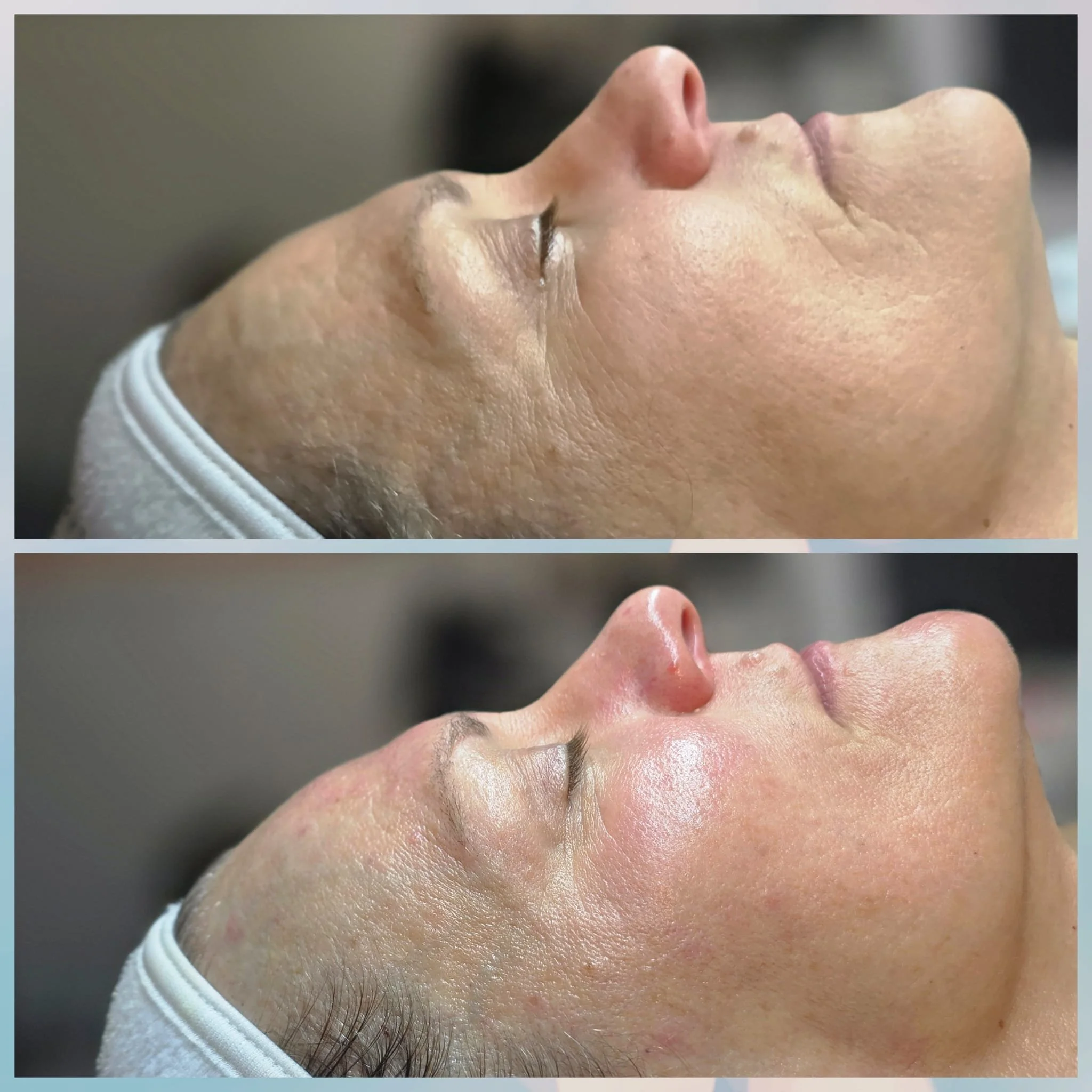 Before and after images of a woman's face showing improved skin texture and brightness after a skincare treatment, both images taken from a side profile with closed eyes and wearing a white headband.