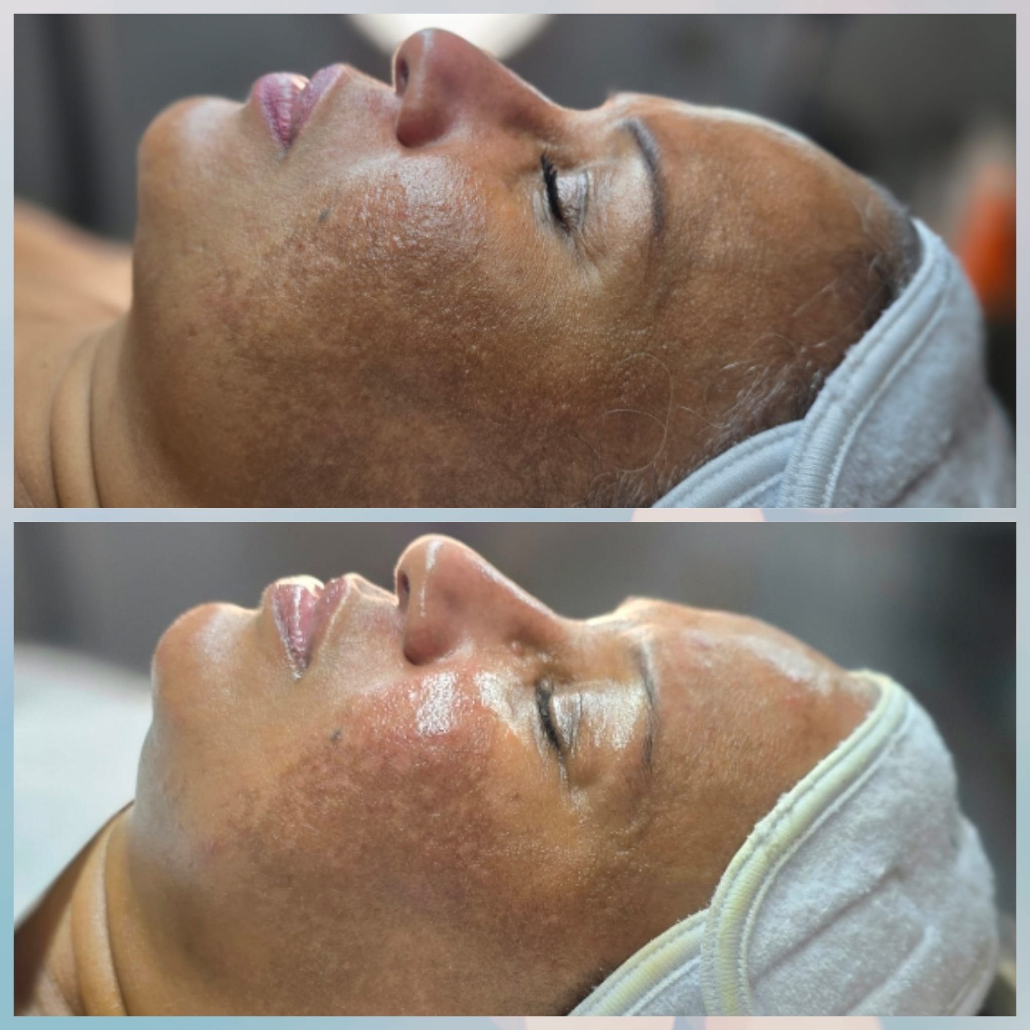 Before and after images of a woman receiving a facial treatment showing improved skin texture and reduced hyperpigmentation.