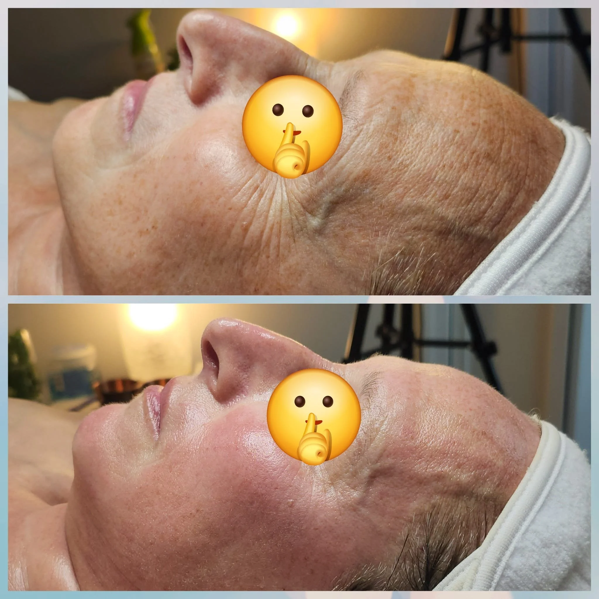 Before and after comparison of facial skin showing improvement in skin texture and reduction of wrinkles on a person's face, with a finger emoji covering the nose area for privacy.