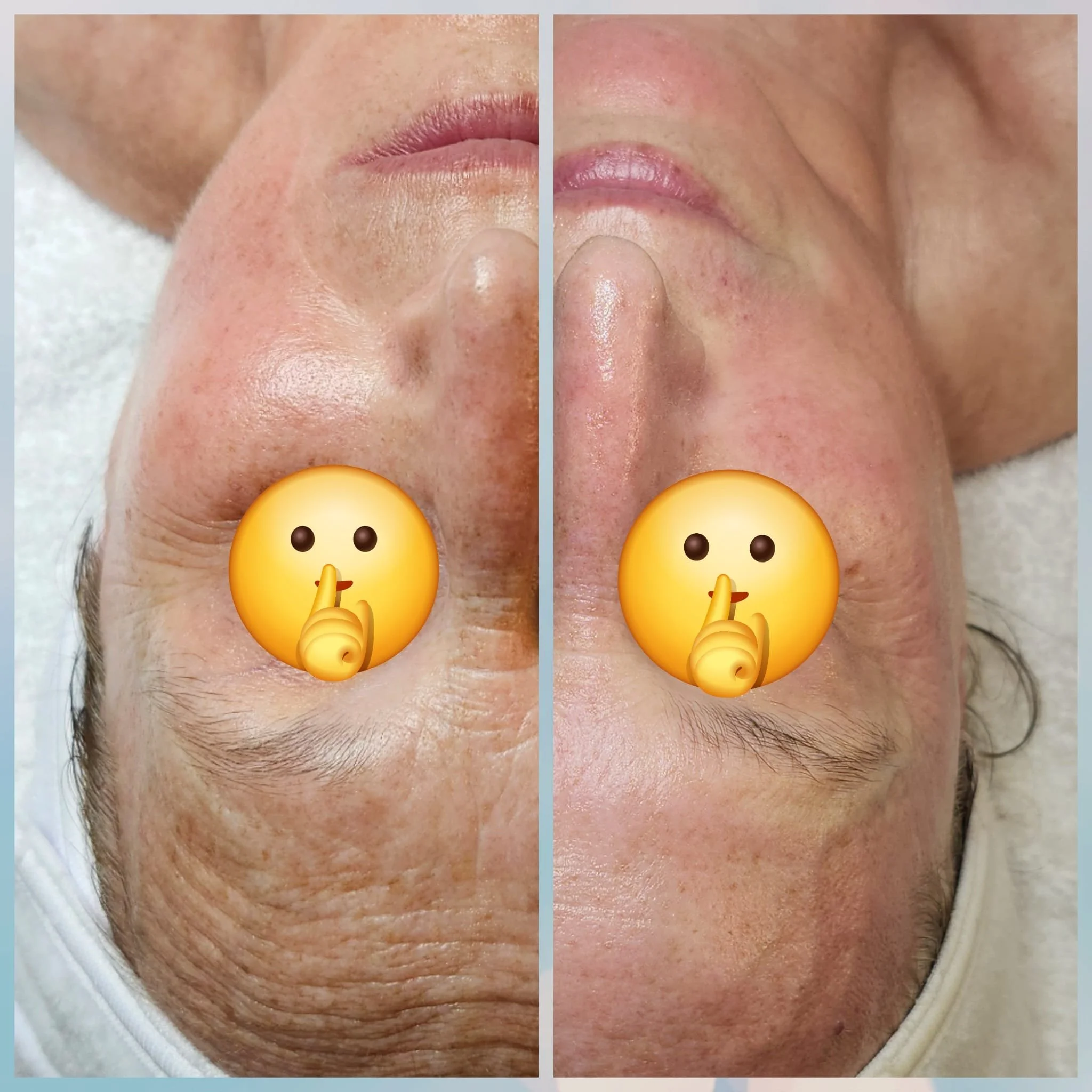 A side-by-side comparison of a person's face before and after a skincare treatment, with a 'shh' emoji covering the mouth area.