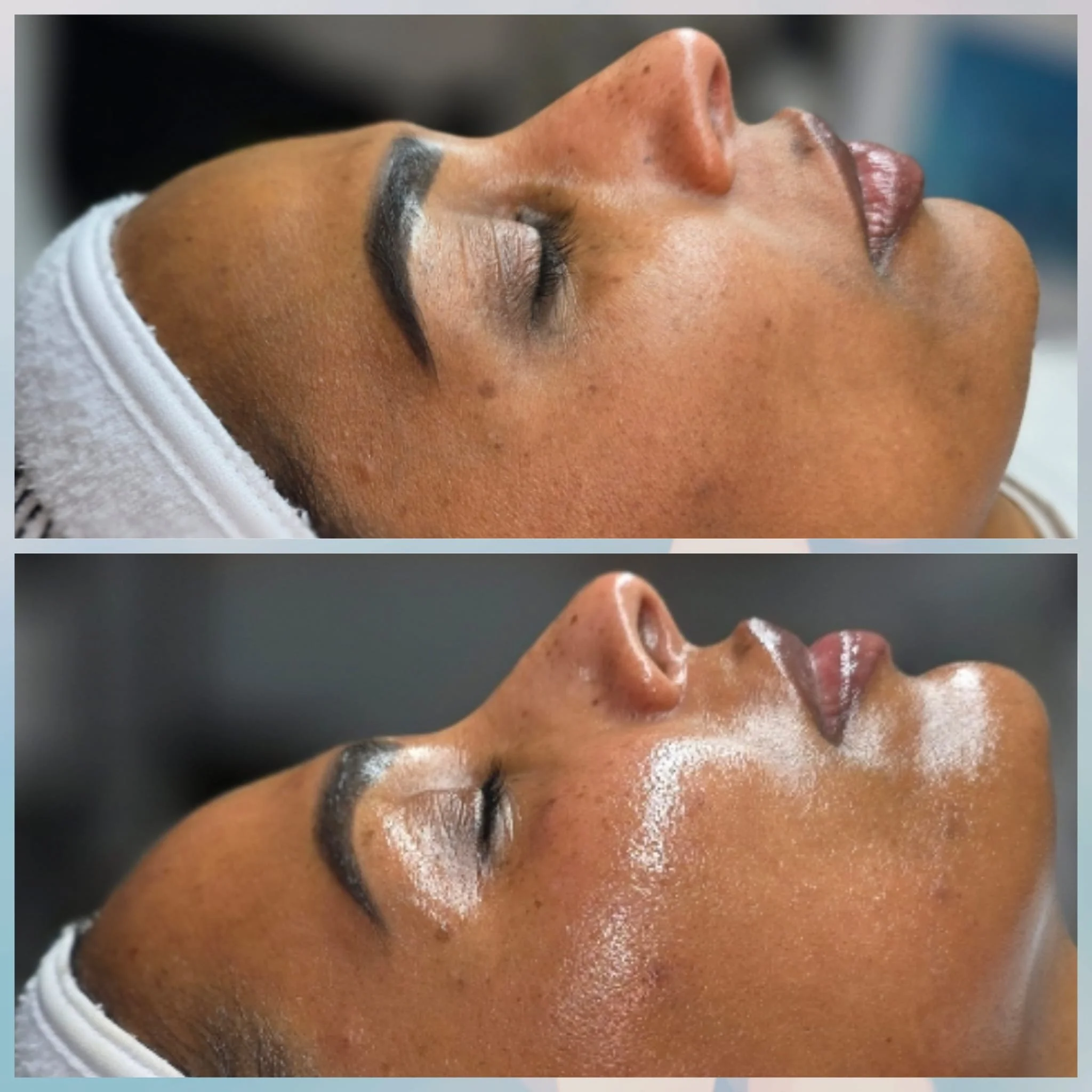 Side-by-side comparison of a woman receiving a facial treatment, showing her lying down with her eyes closed, with a before image on top and an after image on the bottom, highlighting improved skin appearance.
