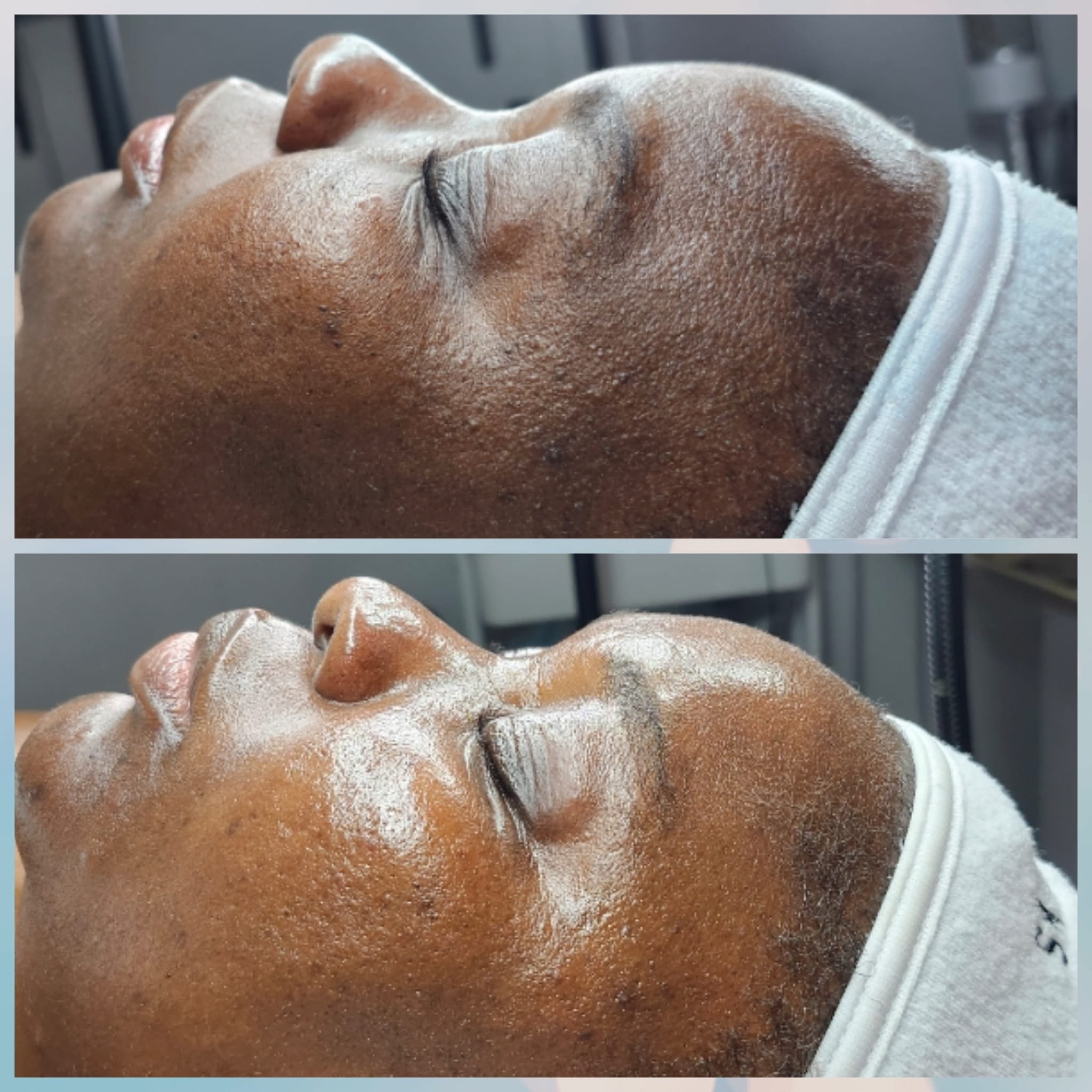 A side-by-side comparison of a person's face before and after a facial treatment, showing improved skin texture and brightness.