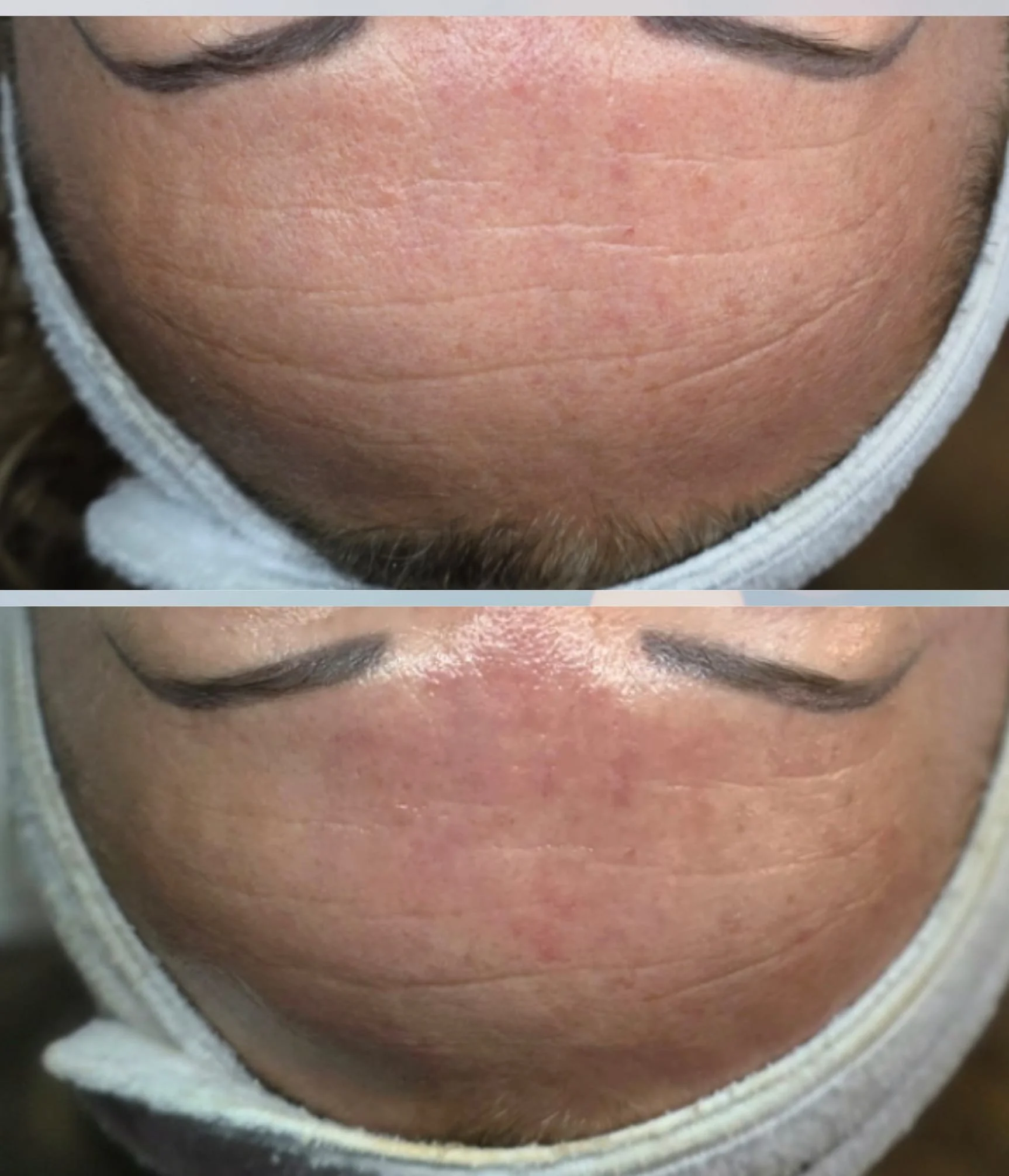 Close-up of chin and jawline showing before and after results of skin treatment, with improvements in skin texture and reduced redness.