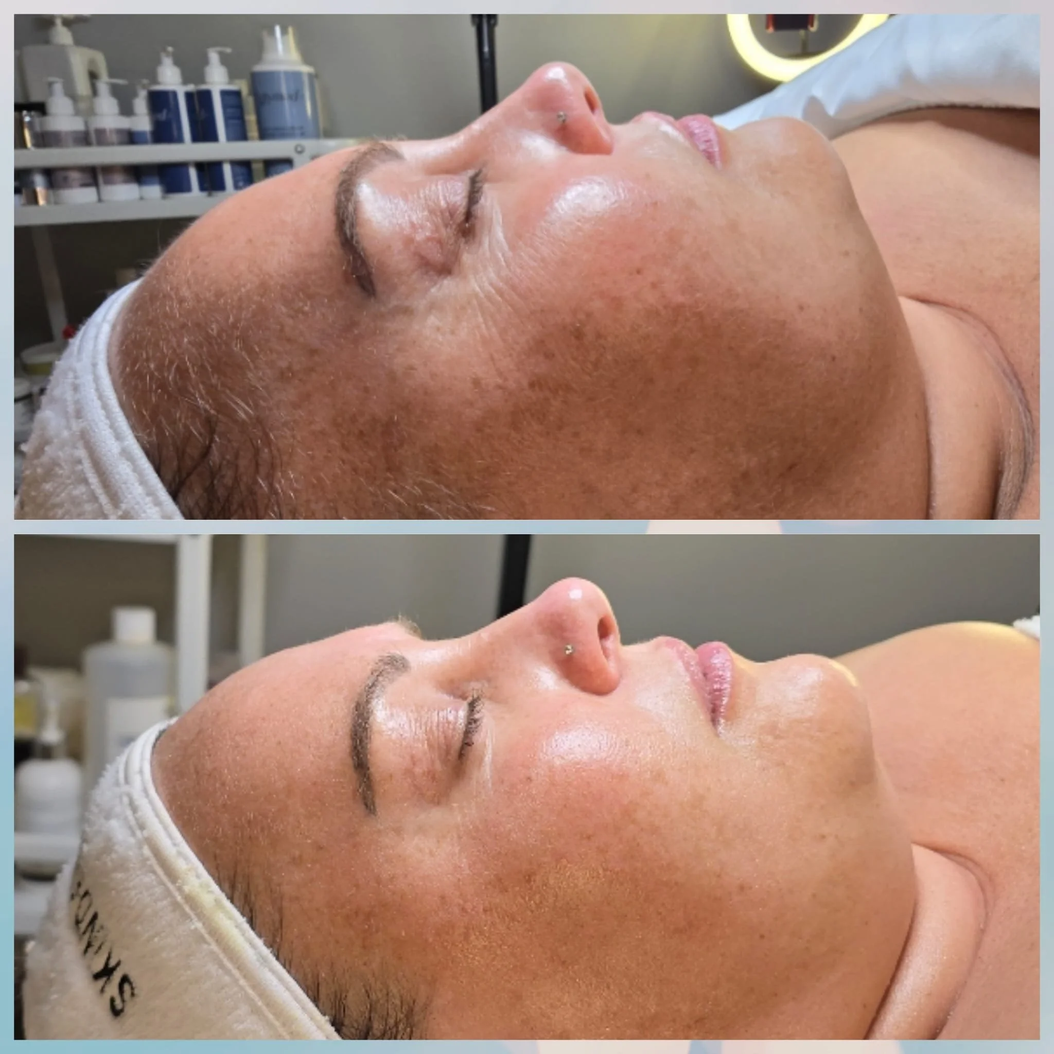 Before and after images of a woman lying down with her eyes closed, showing her face and skin condition, in a skincare treatment. The background includes skincare products and equipment.