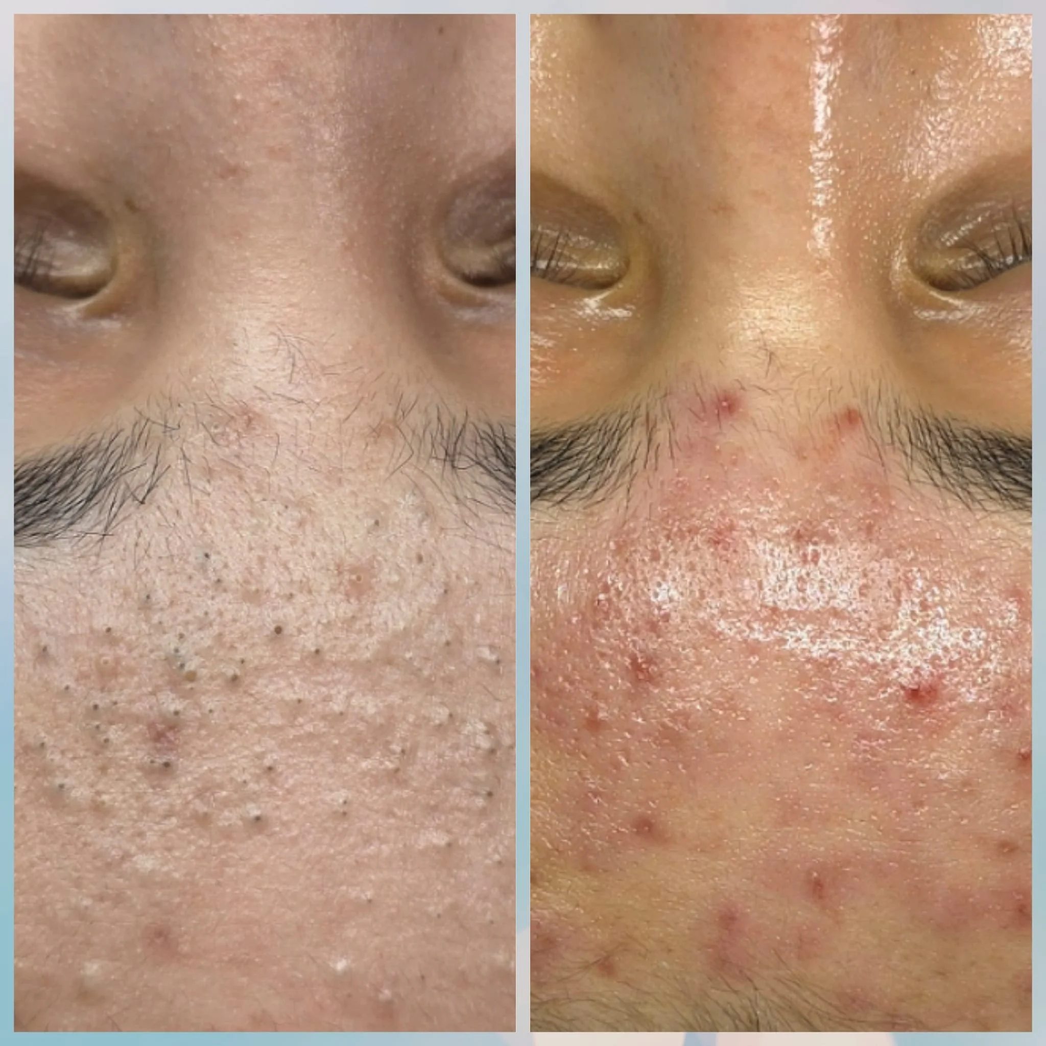 Close-up of a person's face showing before and after treatment of acne and skin texture. The left side depicts inflamed skin with numerous pimples and blackheads, while the right side shows clearer skin with fewer pimples and reduced inflammation.
