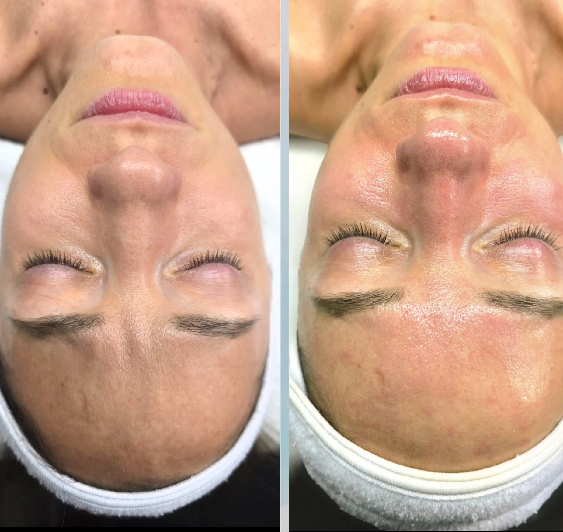 Side-by-side comparison of skin before and after facial treatment, showing improved skin texture and appearance.