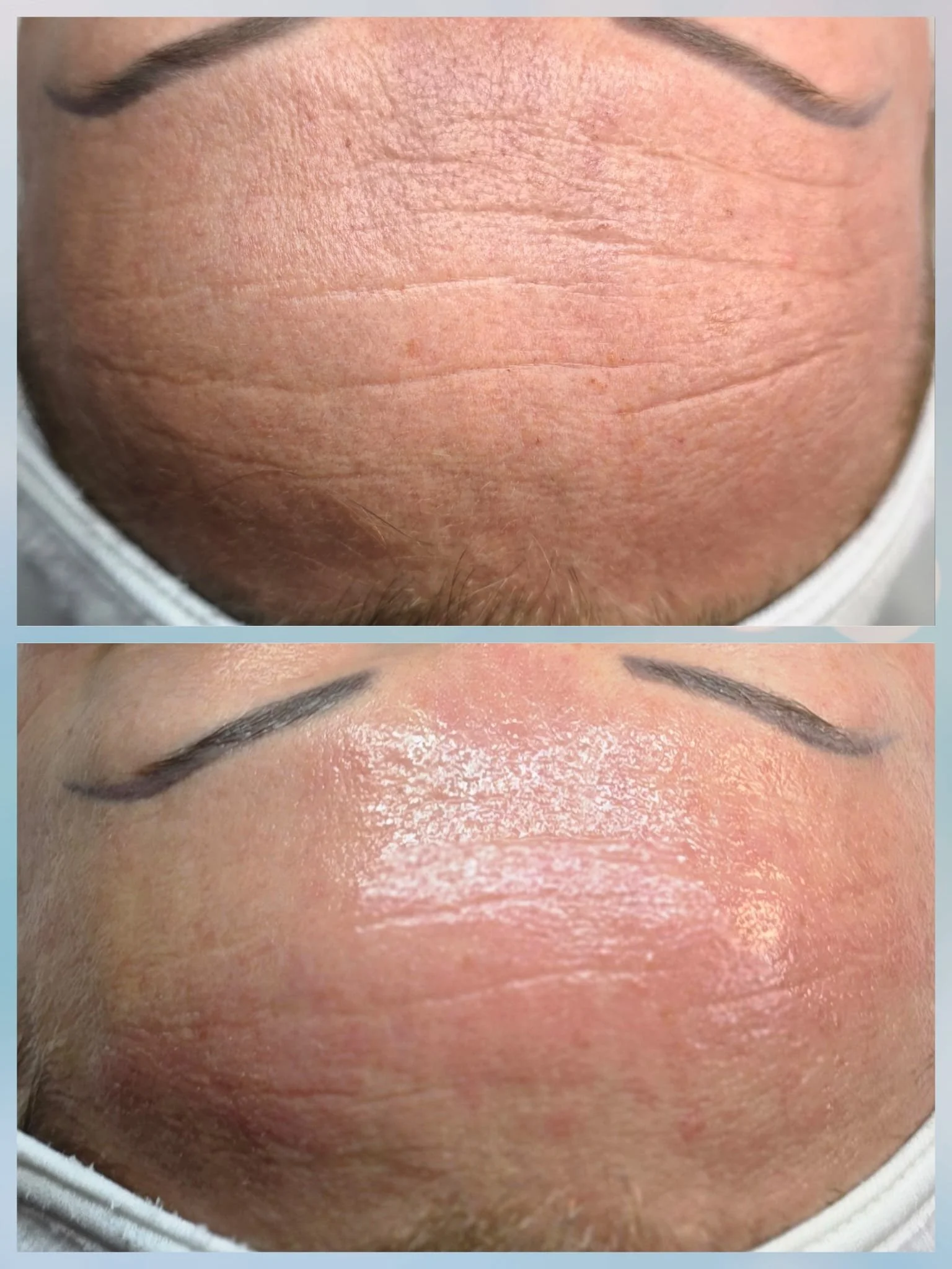 Close-up of a forehead showing before and after skin treatment. The top image displays wrinkles and textured skin; the bottom image shows smooth, shiny skin after treatment.