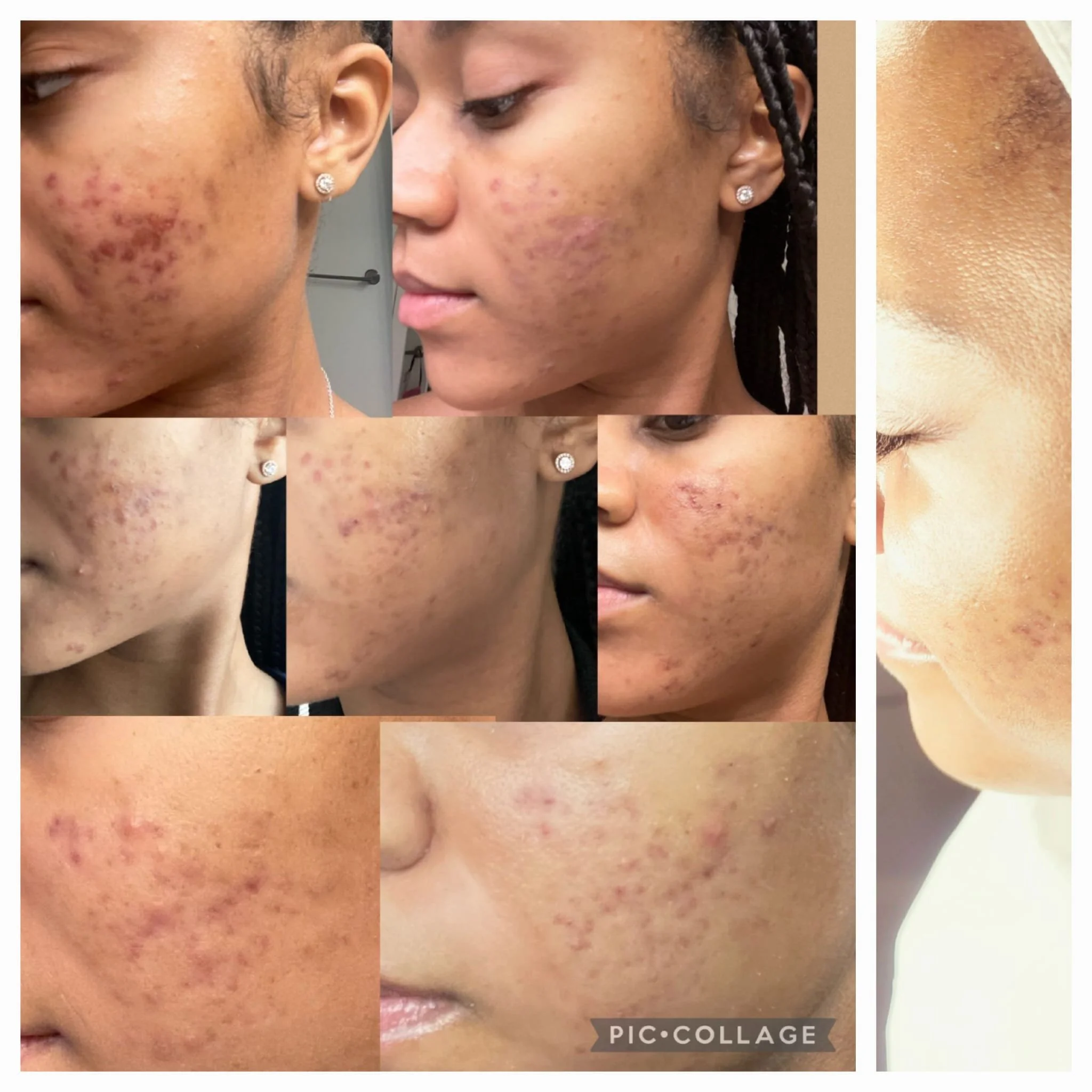 Multiple images showing close-up views of a woman's face with acne and skin imperfections, including redness, scars, and textured skin.