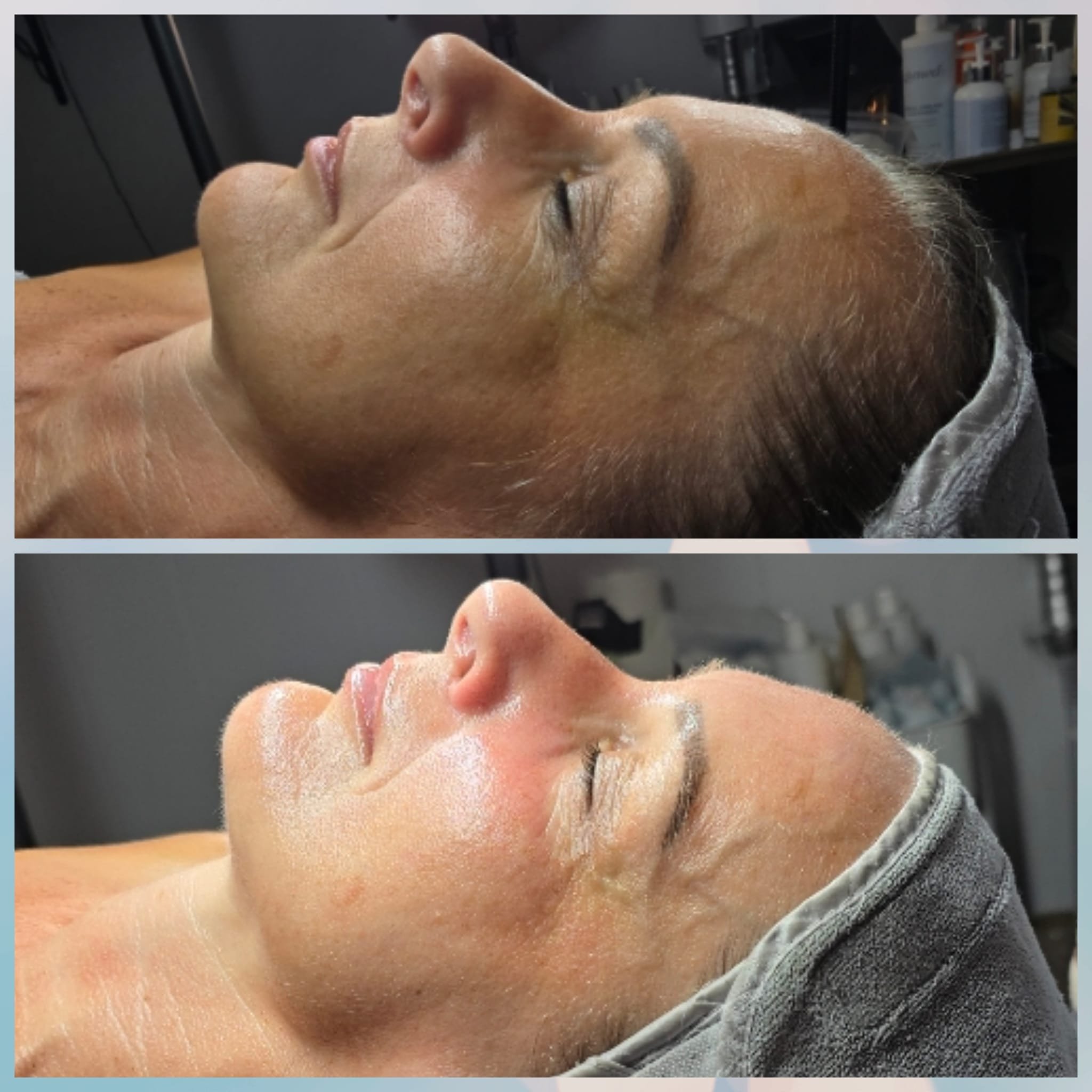 Comparison of a woman's face before and after a skincare treatment, lying on a treatment bed with eyes closed.
