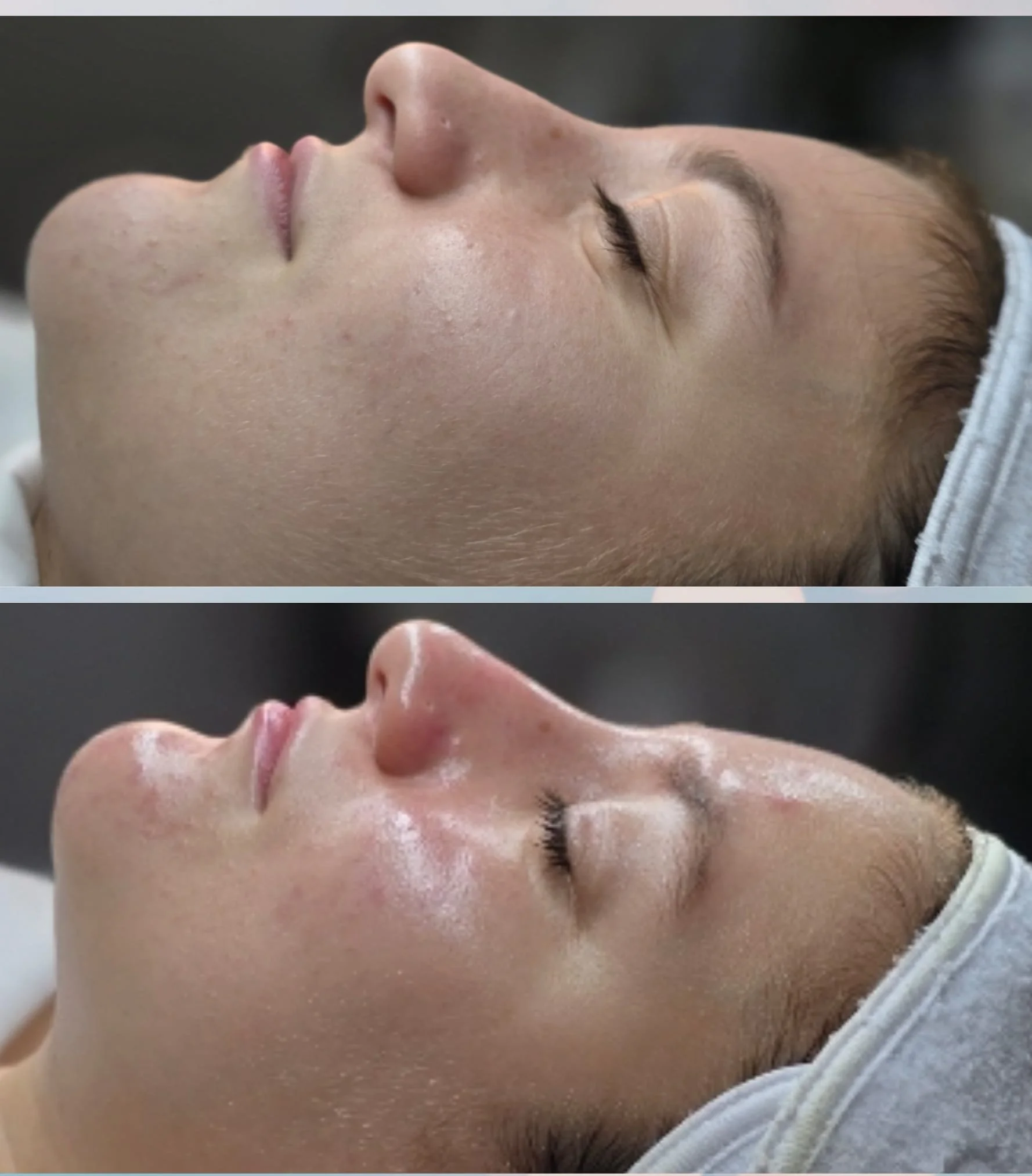 Side-by-side comparison of a woman's face before and after a skincare treatment, showing smoother skin after the procedure.
