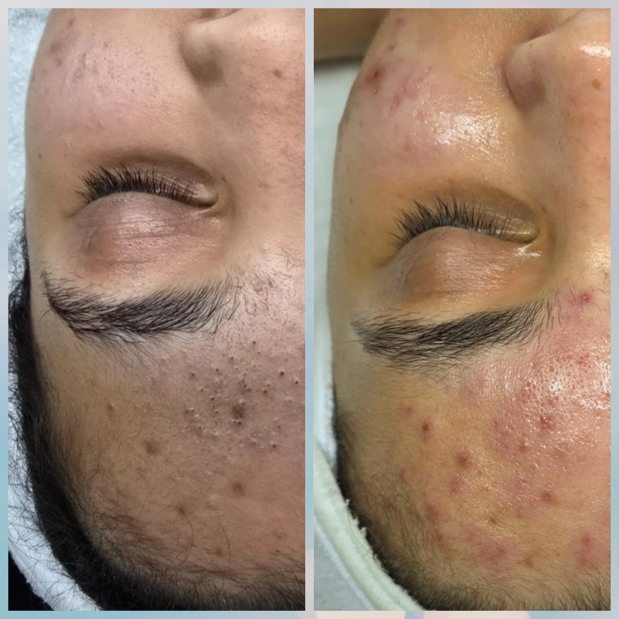 Close-up of a person's face showing before and after treatment for acne, featuring improved skin condition and reduced blemishes.